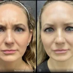 Before and after | frown lines reduction | ANEU Medical Spa | McFarland | Madison, FL