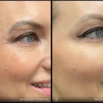 Before and after | eye wrinkles | ANEU Medical Spa | McFarland | Madison, FL