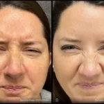 Before and after | sagging skin | ANEU Medical Spa | McFarland | Madison, FL