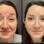 Before and after | forehead wrinkles removal | ANEU Medical Spa | McFarland | Madison, FL