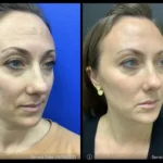 Before and after | dark circle removal | ANEU Medical Spa | McFarland | Madison, FL