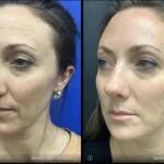 Before and after | dark circles | ANEU Medical Spa | McFarland | Madison, FL