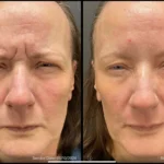 Before and after | skin around eyes | ANEU Medical Spa | McFarland | Madison, FL
