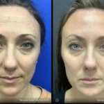 Before and after | under eye bags | ANEU Medical Spa | McFarland | Madison, FL