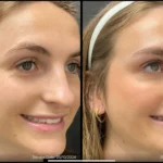 Before and after | fine lines around eyes | ANEU Medical Spa | McFarland | Madison, FL