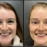 Before and after | skin rejuvenation | ANEU Medical Spa | McFarland | Madison, FL