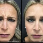 Before and after | frown lines removal | ANEU Medical Spa | McFarland | Madison, FL