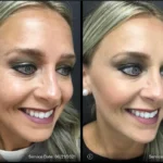 Before and after | fine lines | ANEU Medical Spa | McFarland | Madison, FL
