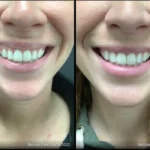 Before and after | gum recession treatment | ANEU Medical Spa | McFarland | Madison, FL