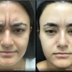 frown before and after | ANEU Medical Spa | McFarland | Madison, FL