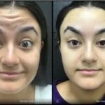 before and after treatment | a woman's face | ANEU Medical Spa | McFarland | Madison, FL