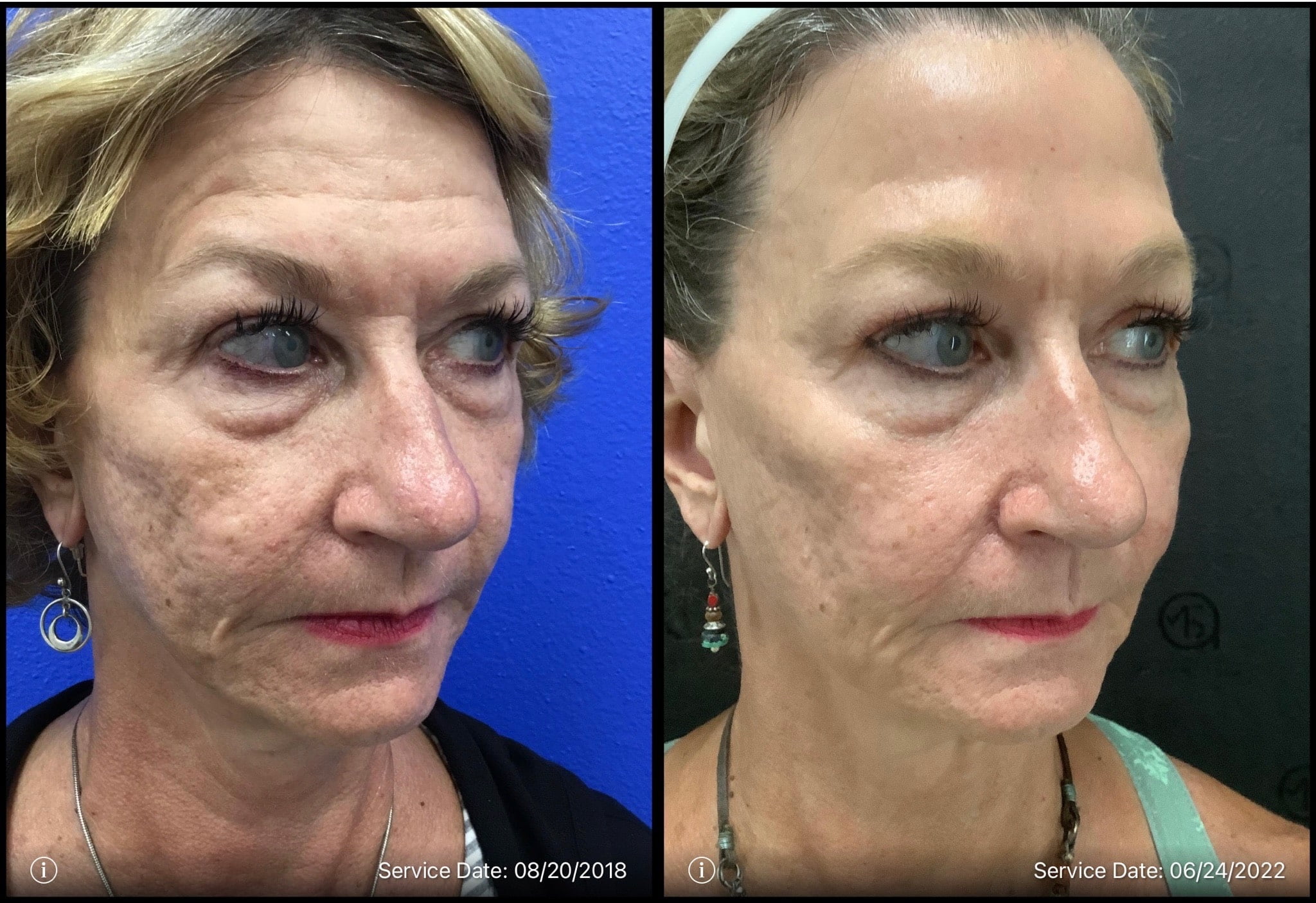 Before and After Total Transformation in McFarland, WI | ANEU Medical Spa McFarland, WI