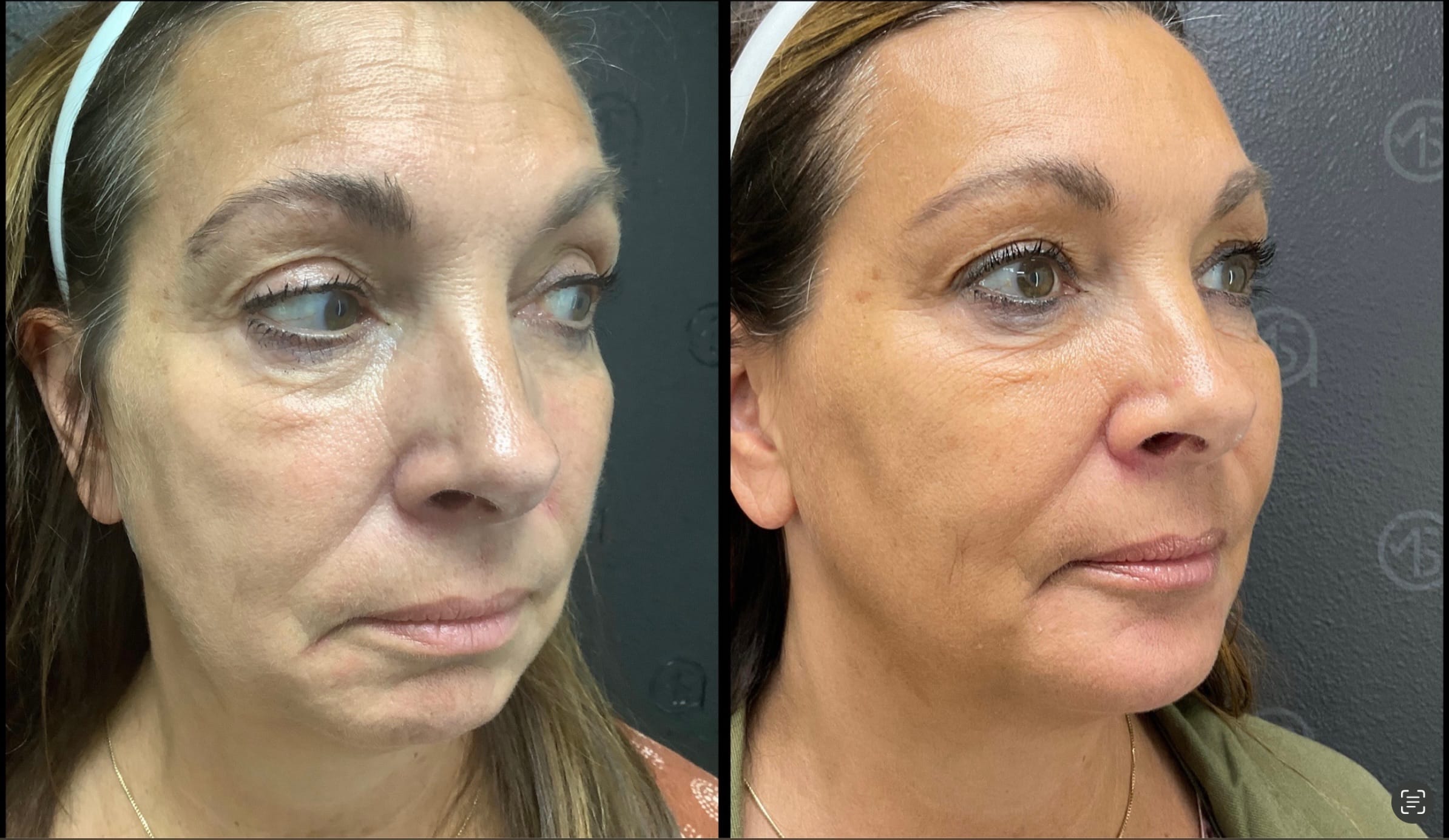 Medical Total Transformation in McFarland, WI | ANEU Medical Spa McFarland, WI