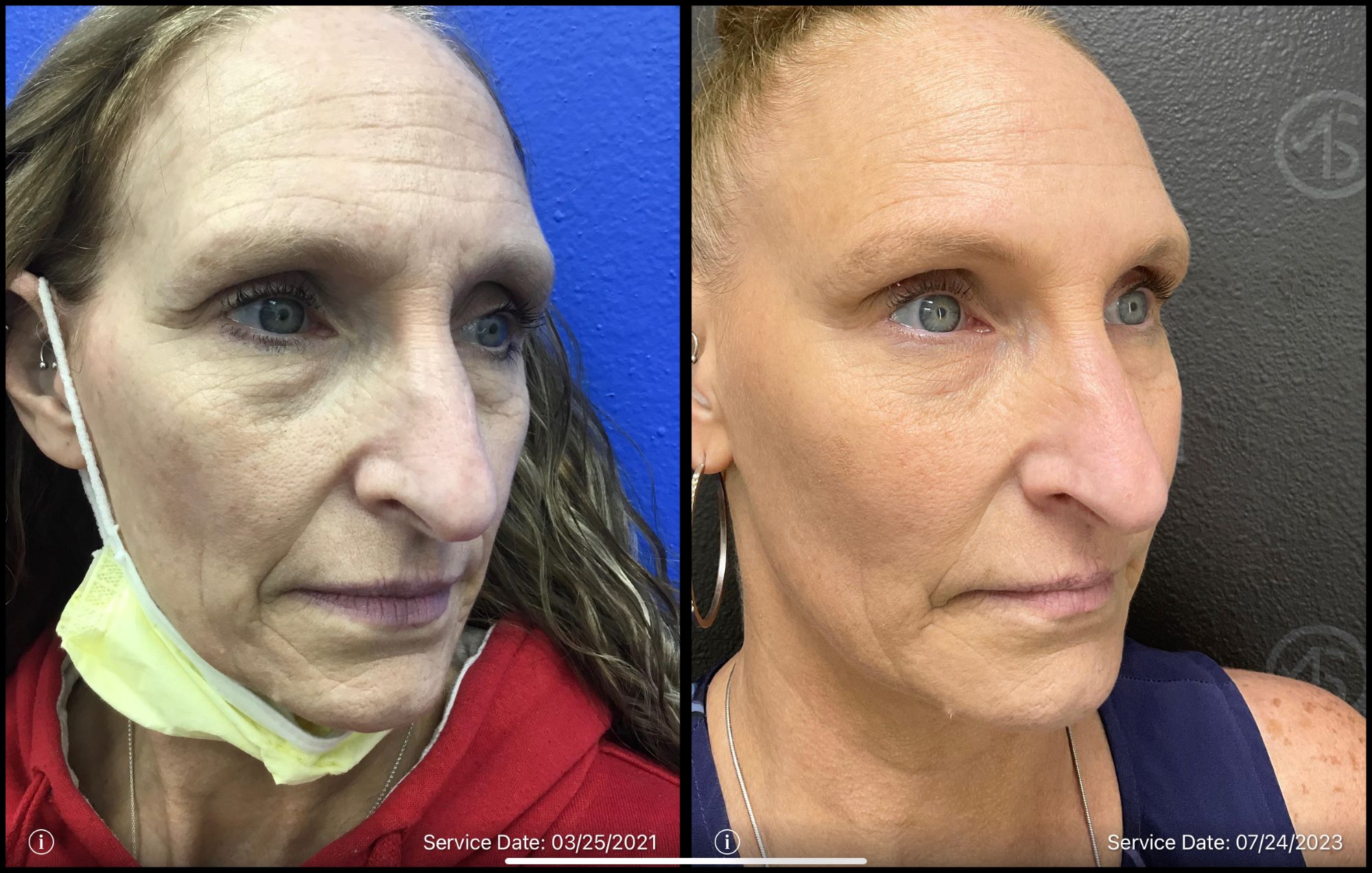 Before and After Total Transformation in McFarland, WI | ANEU Medical Spa McFarland, WI