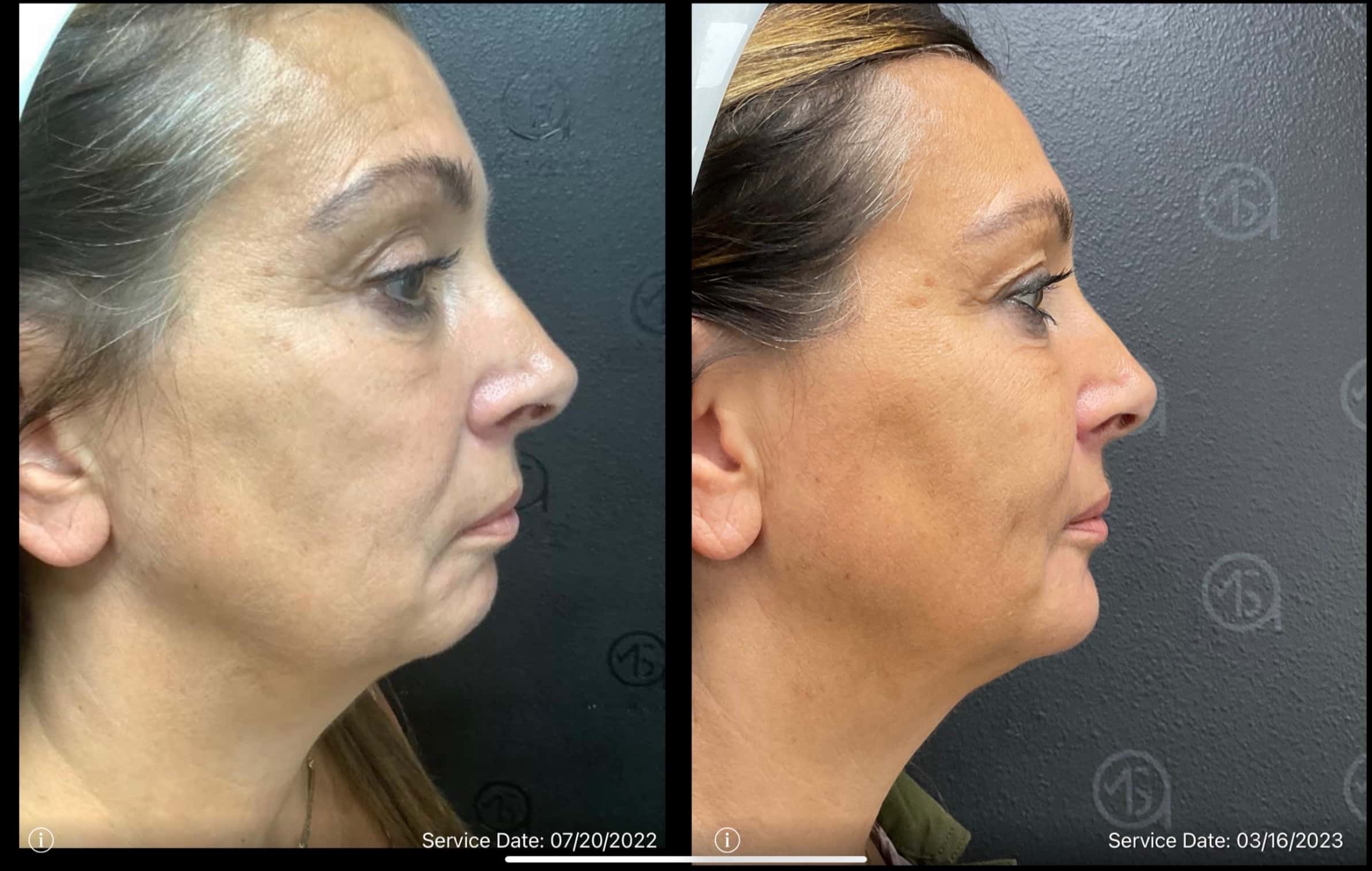 Before and After Total Transformation in McFarland, WI | ANEU Medical Spa McFarland, WI