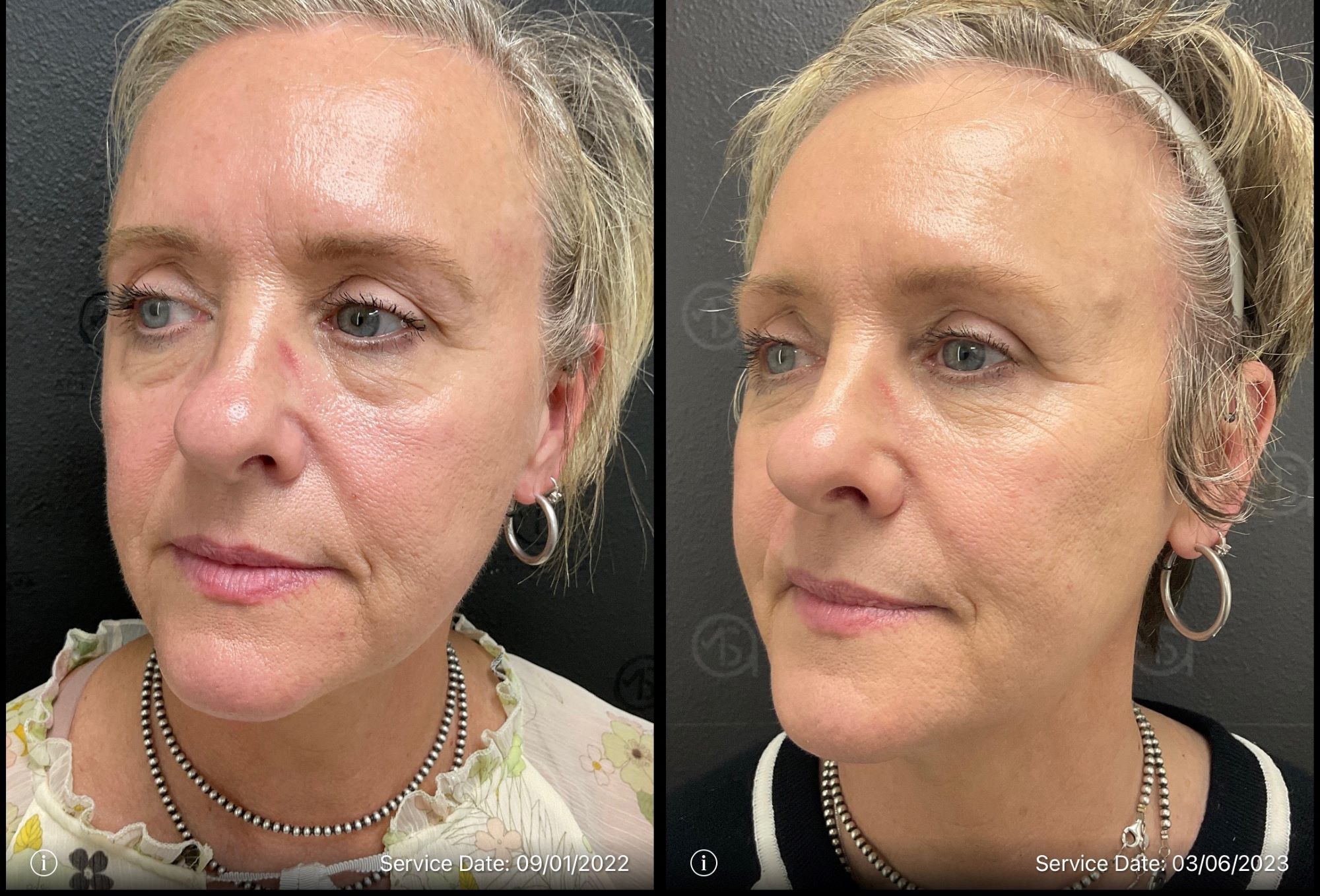 Before and After Total Transformation in McFarland, WI | ANEU Medical Spa McFarland, WI