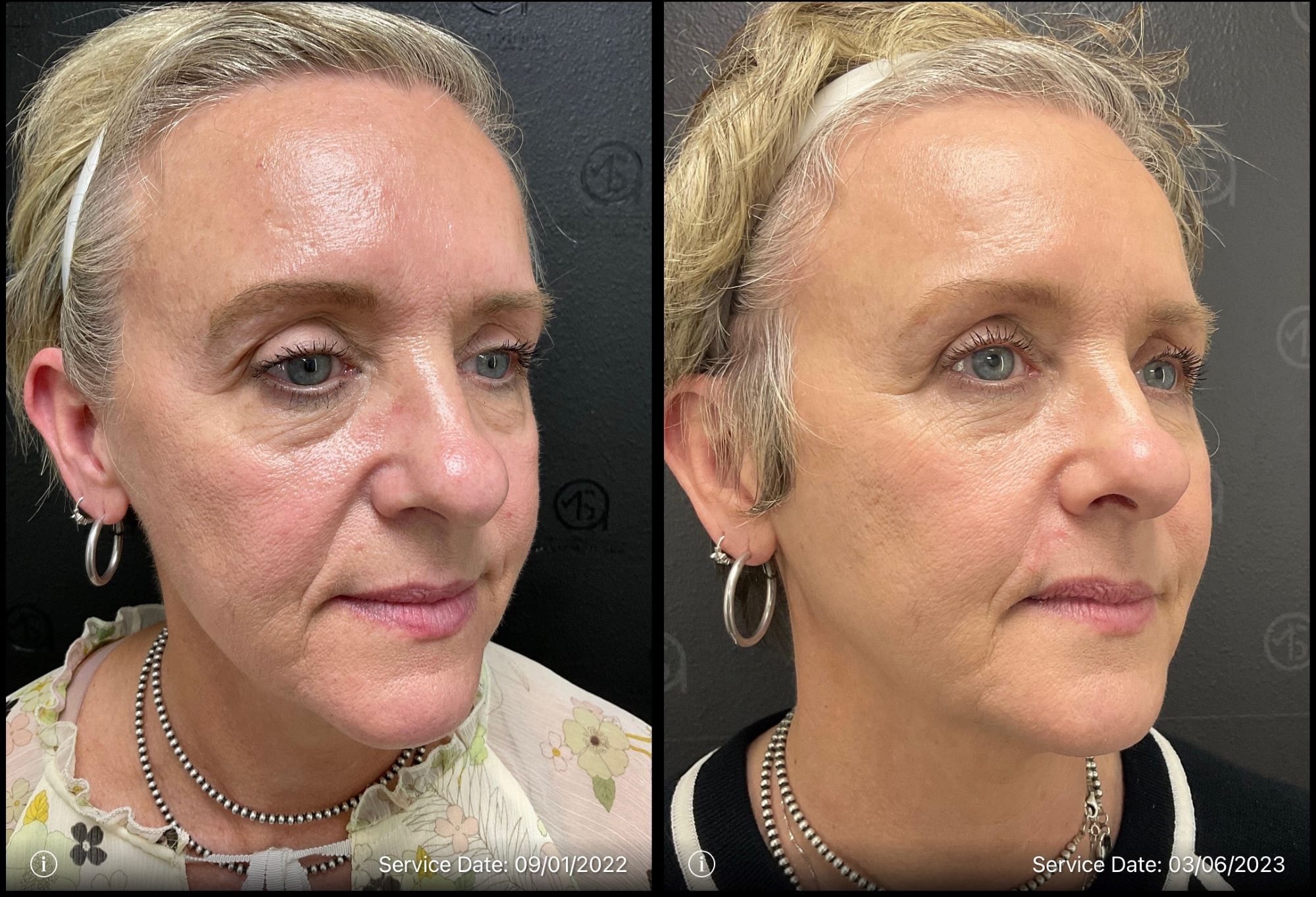 Before and After Total Transformation in McFarland, WI | ANEU Medical Spa McFarland, WI