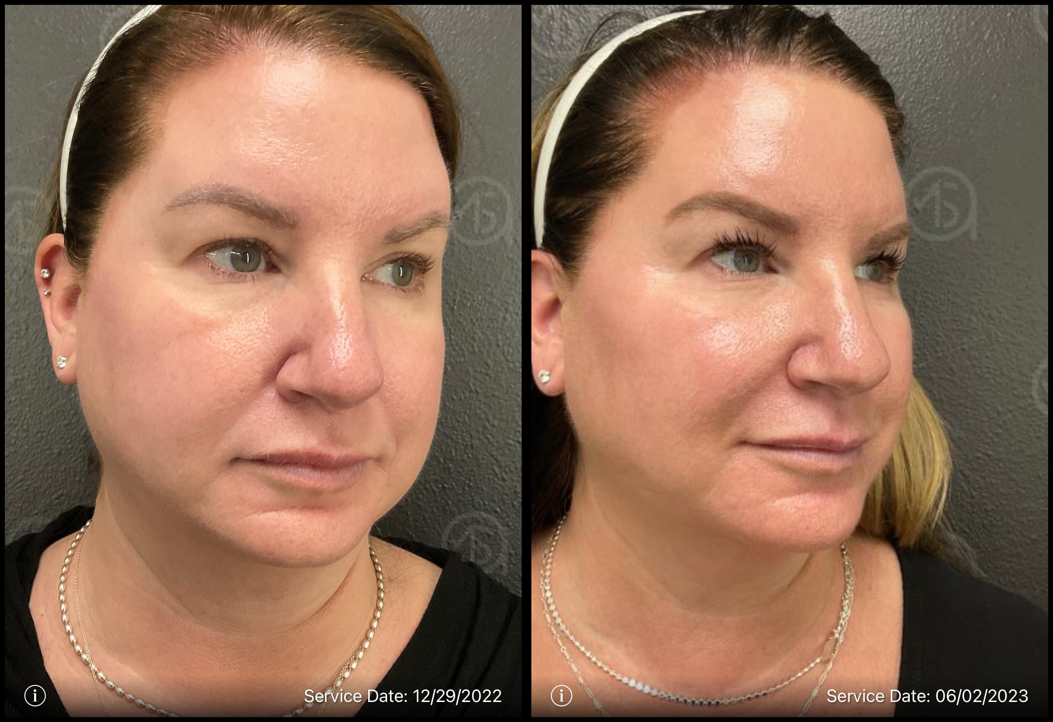 Before and After Total Transformation in McFarland, WI | ANEU Medical Spa McFarland, WI