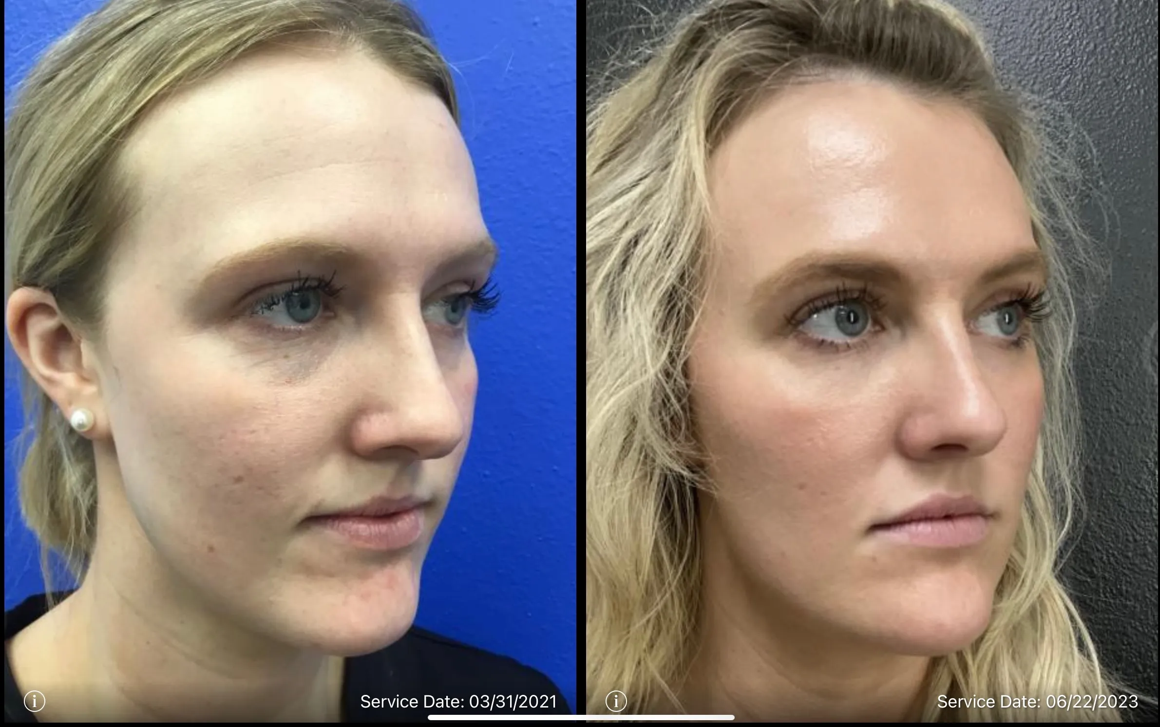 Under eye before and after | ANEU Medical Spa | McFarland | Madison, FL