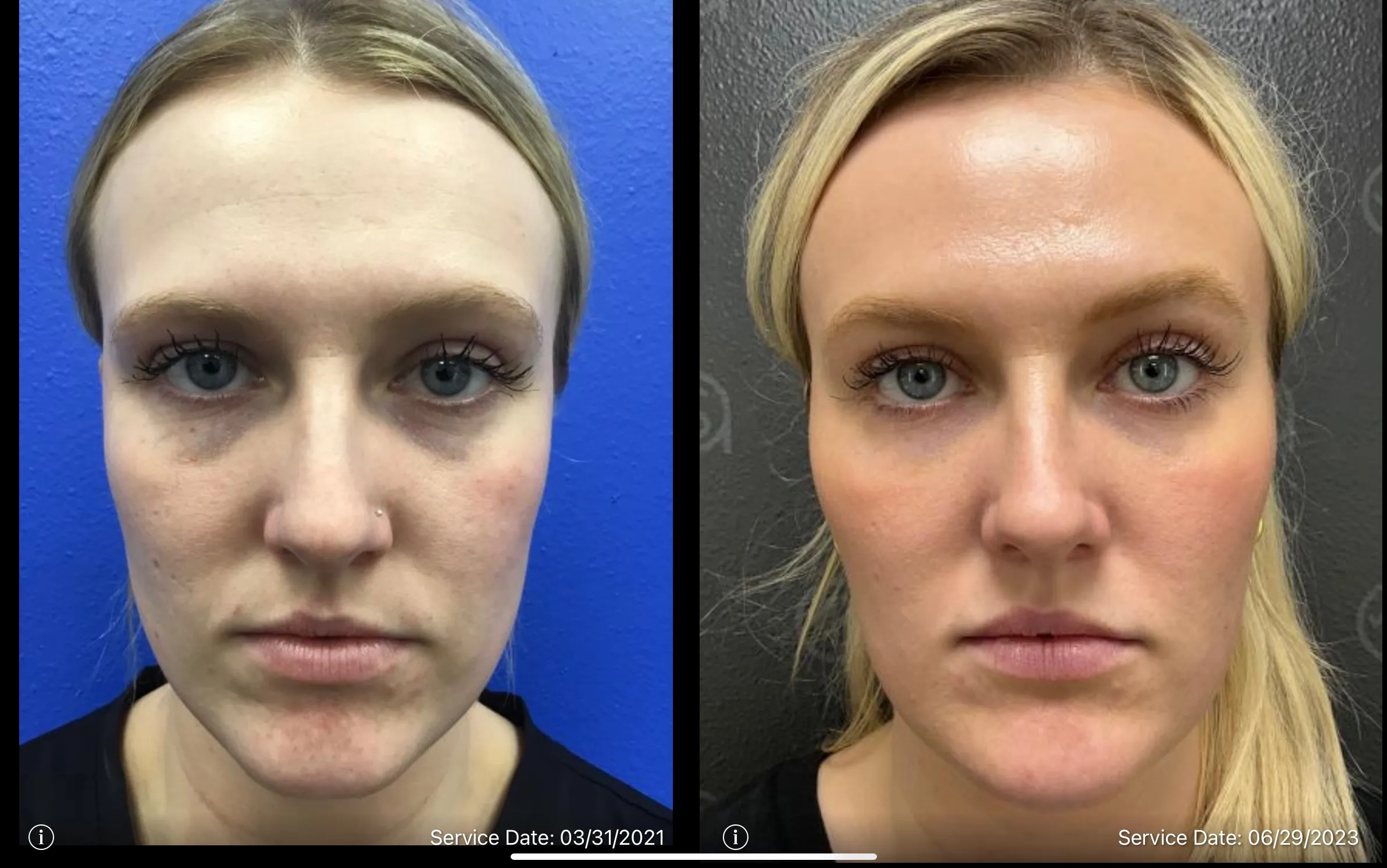 under eye dark circles before and after | ANEU Medical Spa | McFarland | Madison, FL