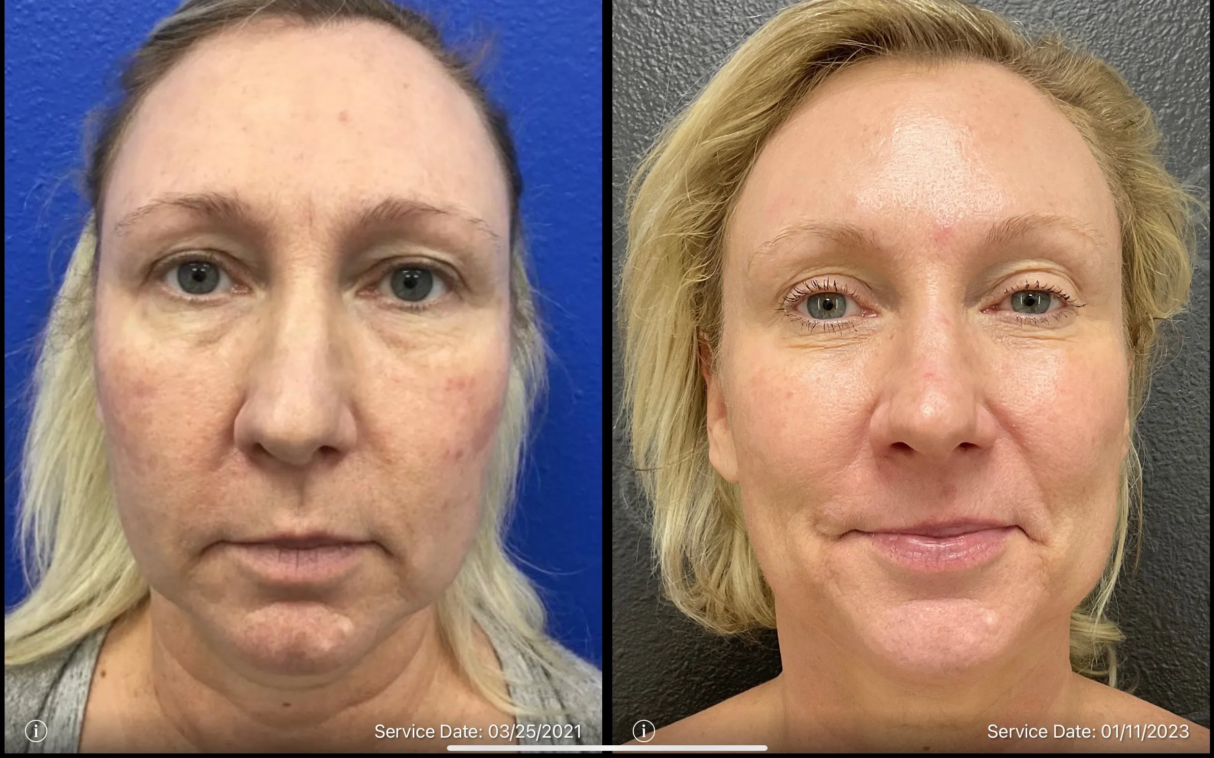 Skin rejuvenation before and after | ANEU Medical Spa | McFarland | Madison, FL