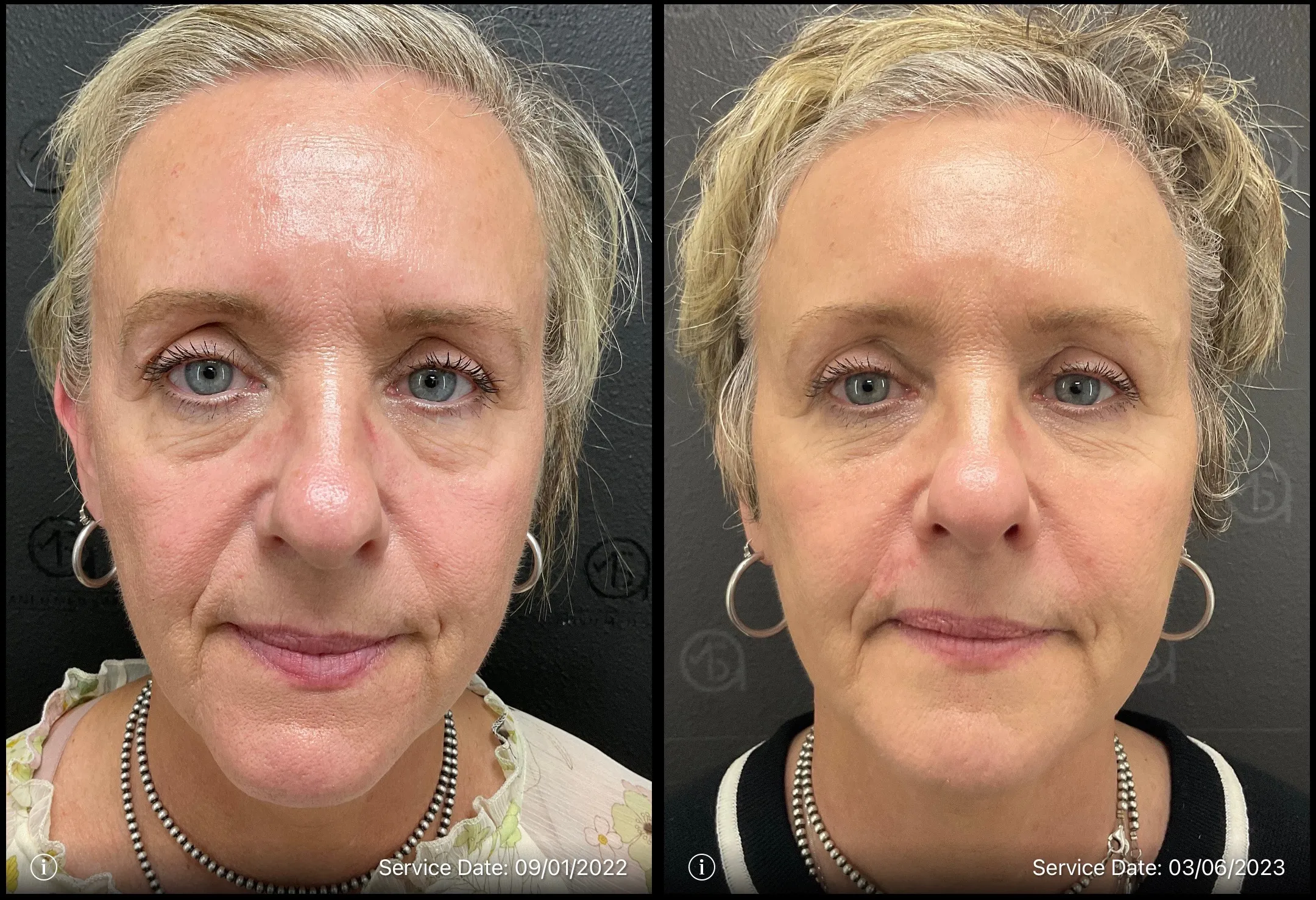 eye bags before and after | ANEU Medical Spa | McFarland | Madison, FL