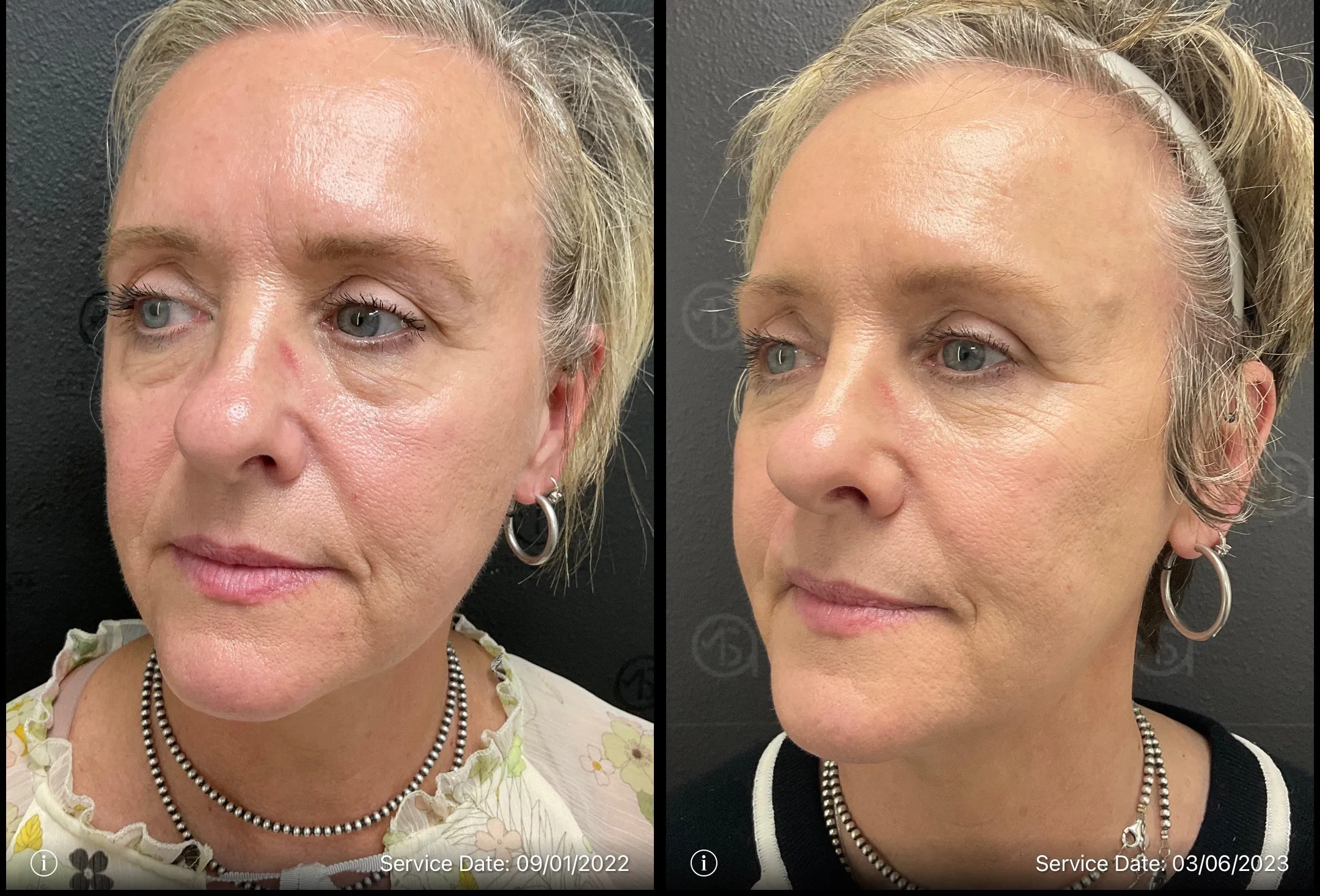 Eye circle treatment | before and after | ANEU Medical Spa | McFarland | Madison, FL