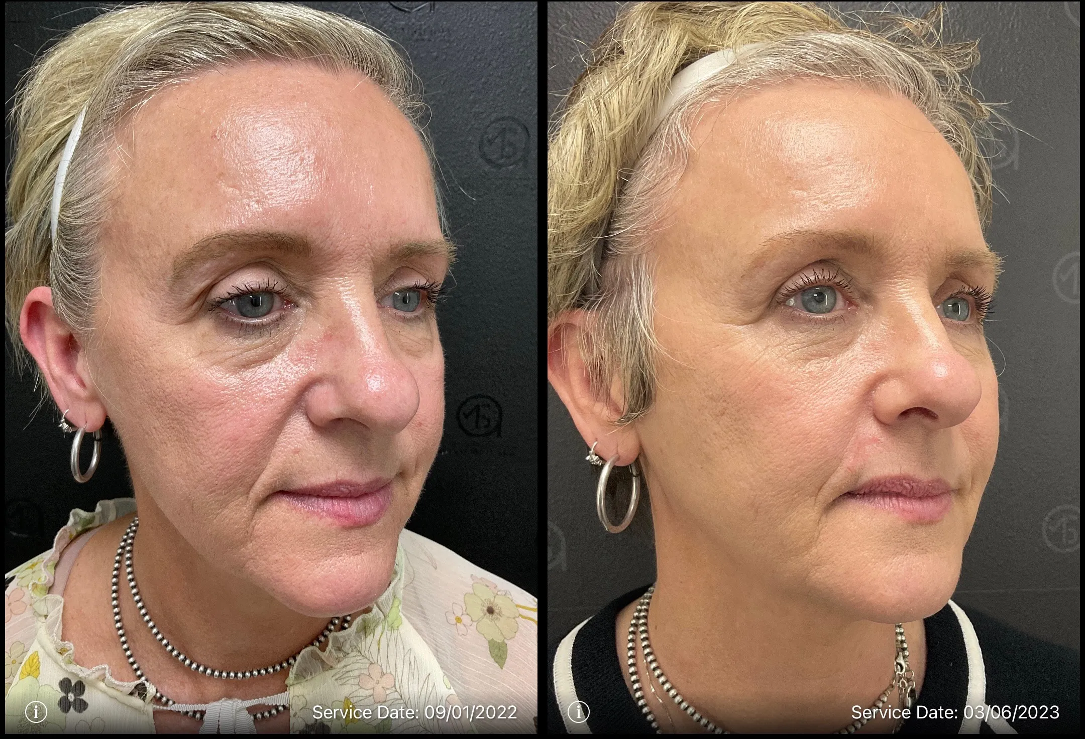 side face | before and after photo | ANEU Medical Spa | McFarland | Madison, FL