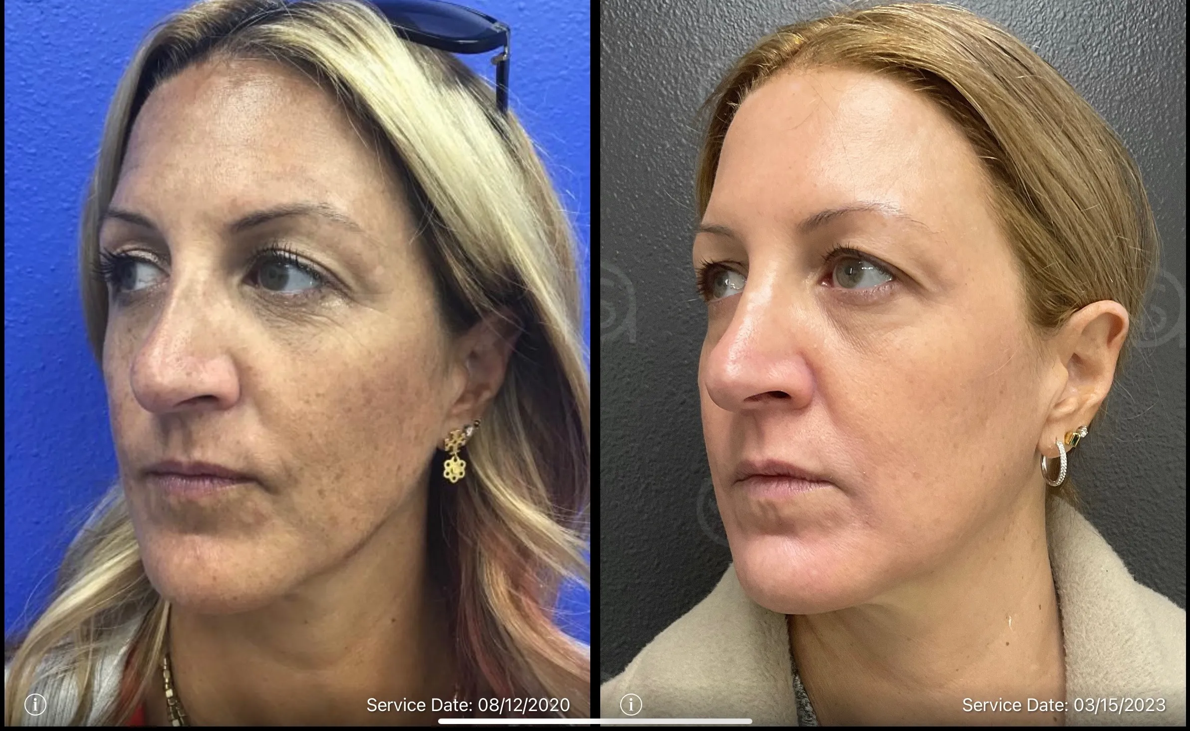 facial Rejuvenation before and after photo | ANEU Medical Spa | McFarland | Madison, FL