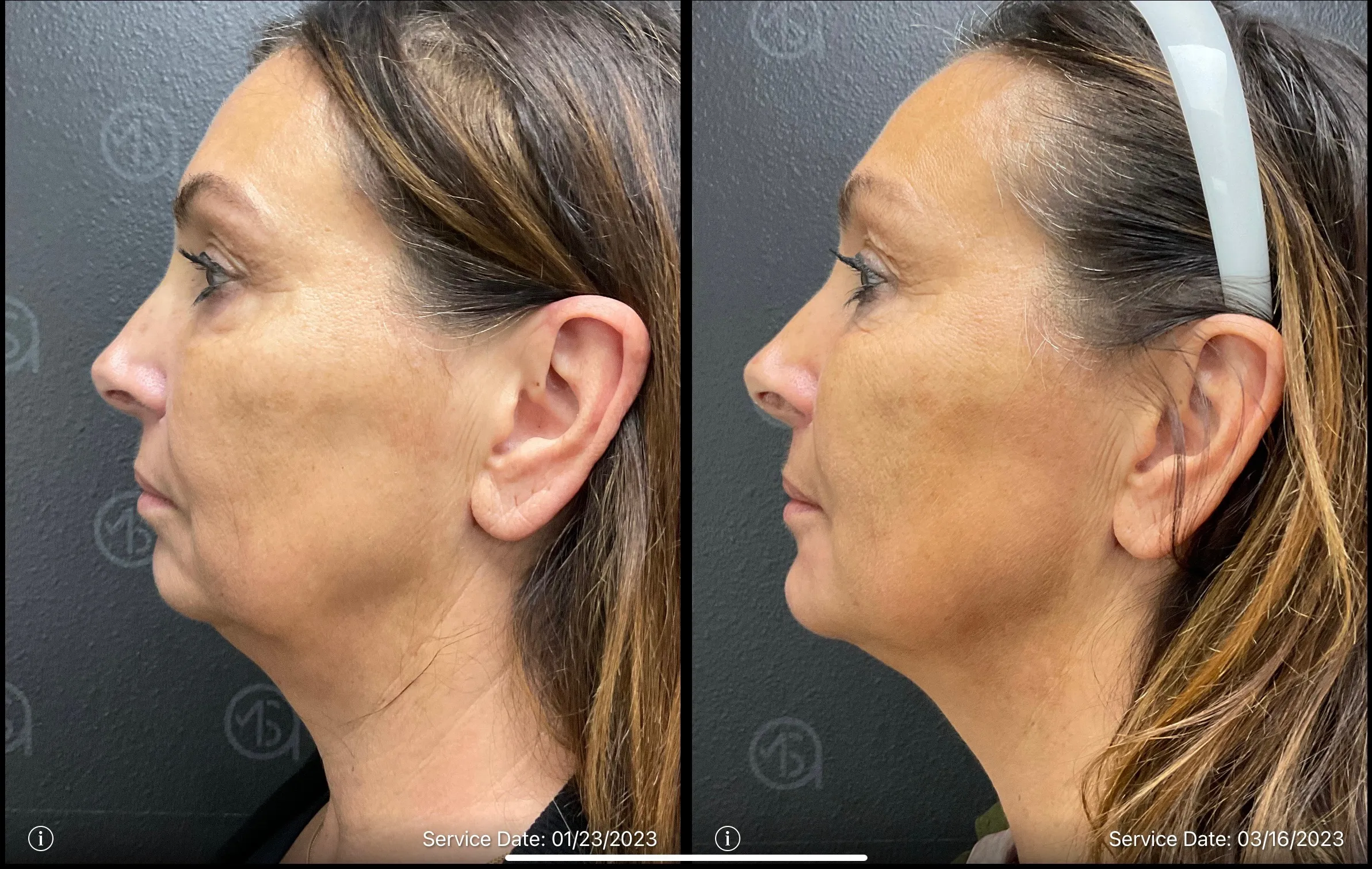 chin augmentation | before and after | ANEU Medical Spa | McFarland | Madison, FL