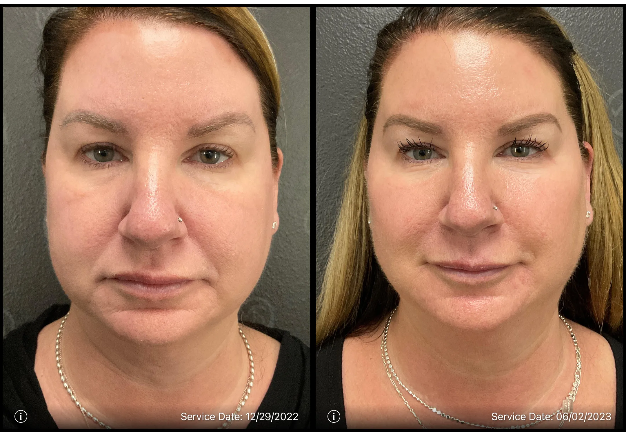 Before and after photo | Skin treatment | ANEU Medical Spa, LLC | McFarland | Madison, WI