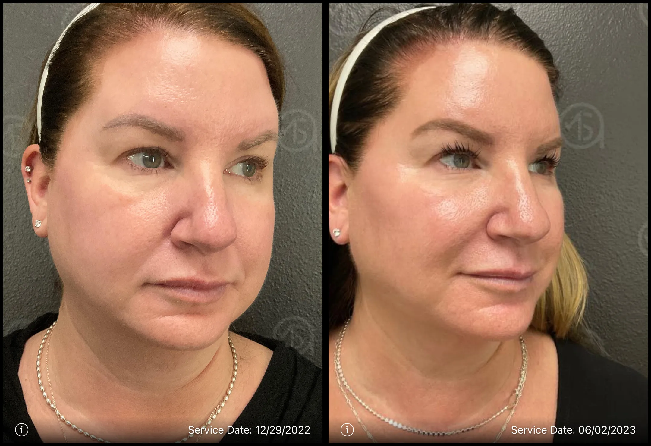 Before and after photo | Skin care treatment | ANEU Medical Spa, LLC | McFarland | Madison, WI