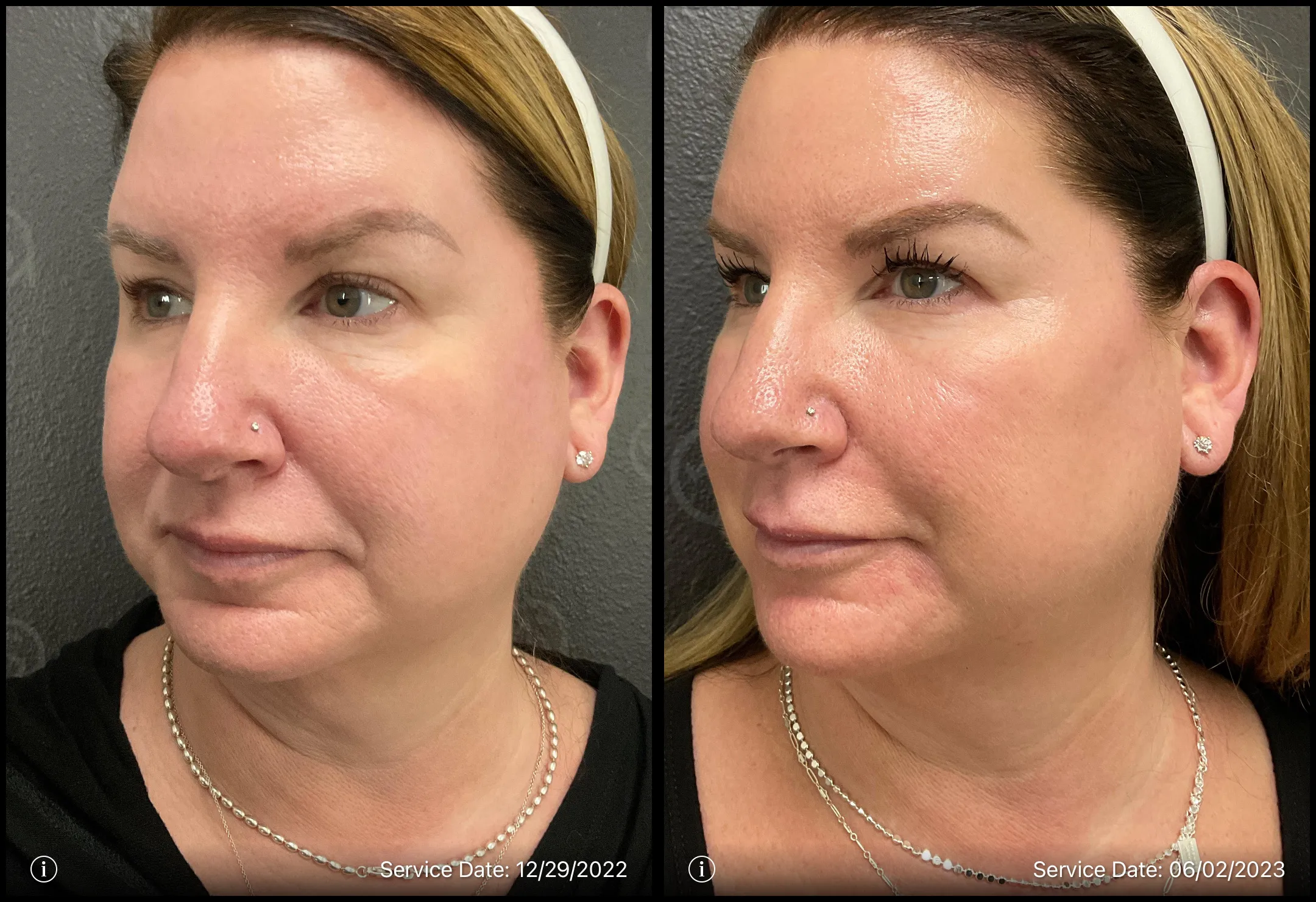 Before and after | side profile | Skin treatment | ANEU Medical Spa, LLC | McFarland | Madison, WI