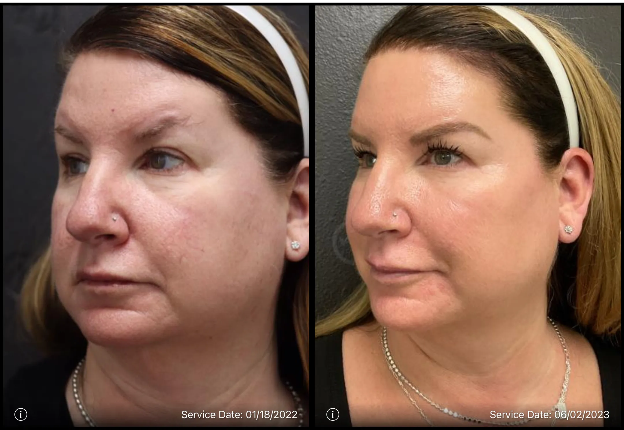 Before and after photo | botox | ANEU Medical Spa, LLC | McFarland | Madison, WI