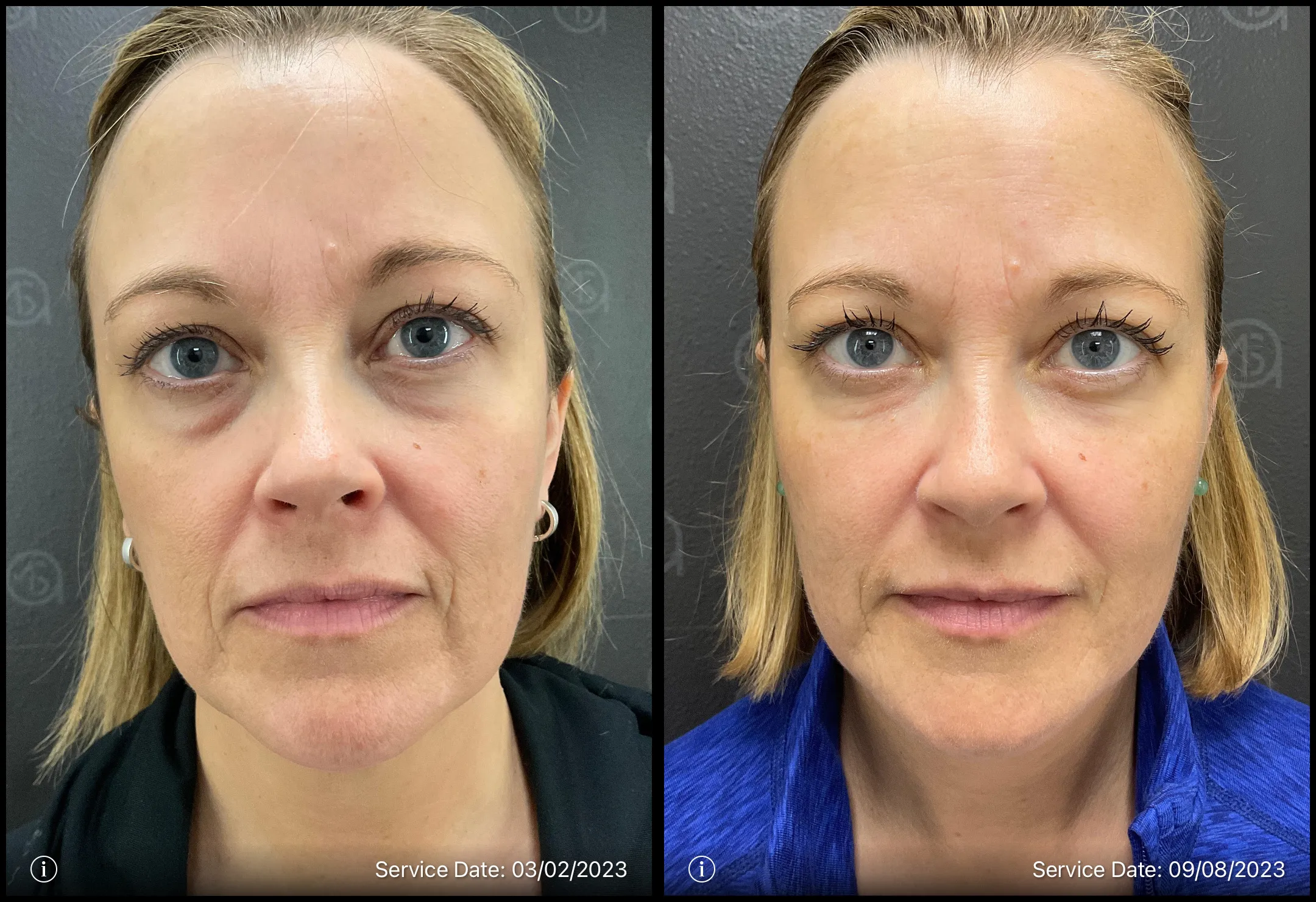 Before and after photo | under eye bags treatment | ANEU Medical Spa, LLC | McFarland | Madison, WI