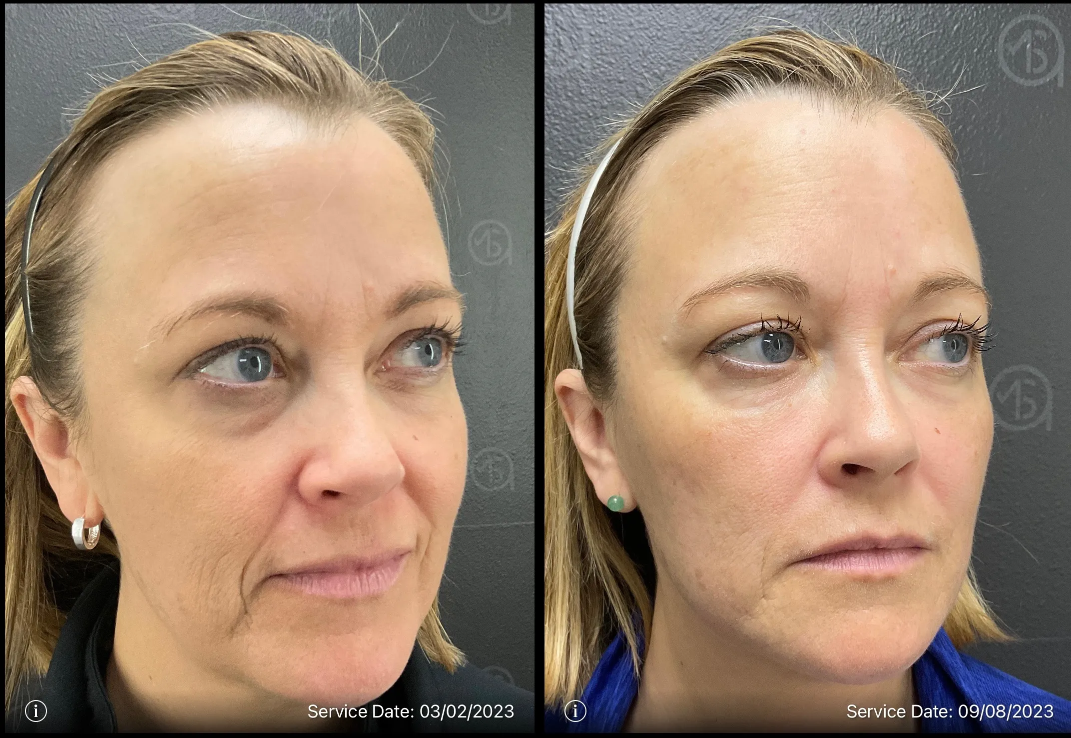 Before and after photo | under eye skin treatment | ANEU Medical Spa, LLC | McFarland | Madison, WI