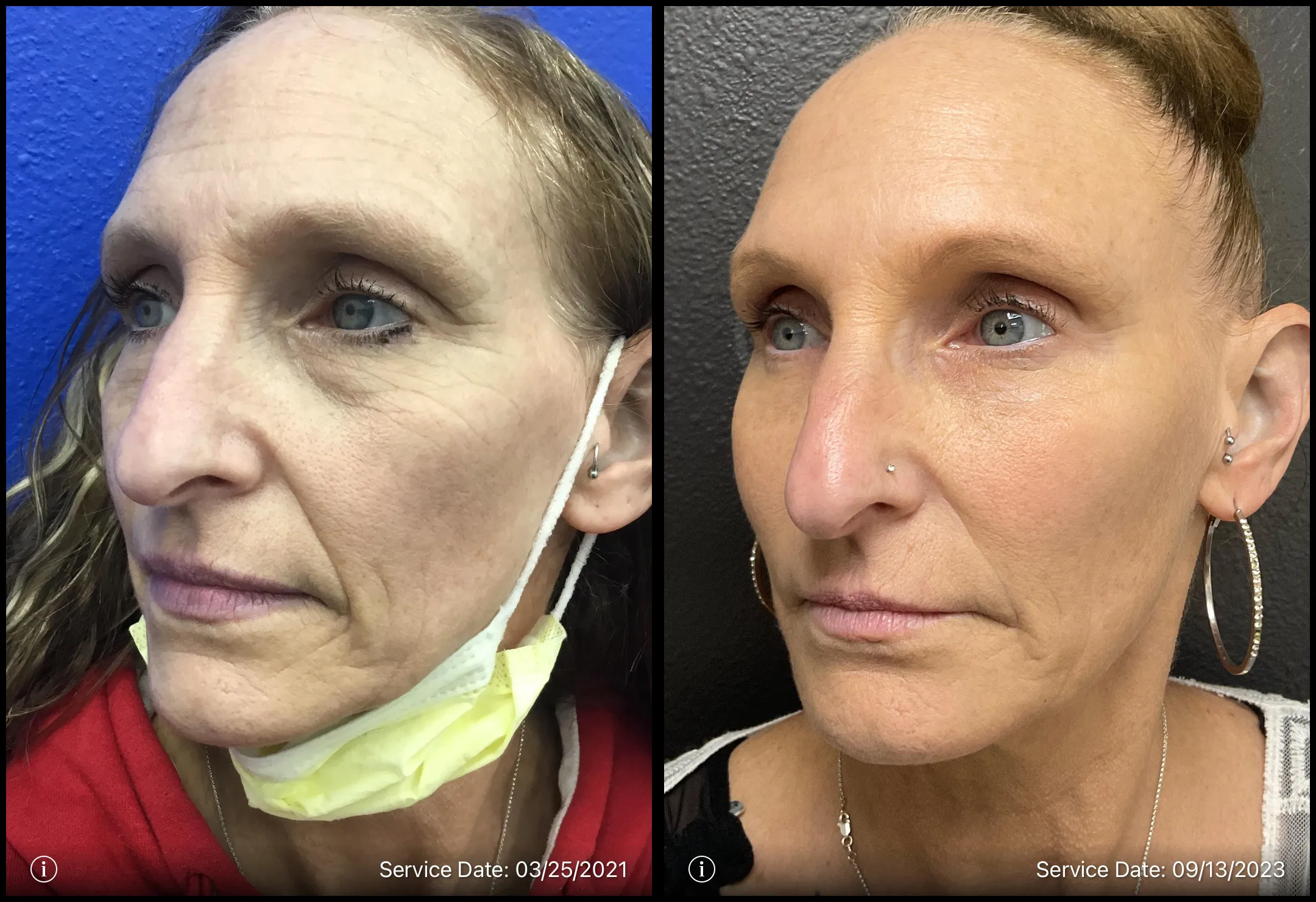 Before and after | wrinkles treatment | ANEU Medical Spa, LLC | McFarland | Madison, WI