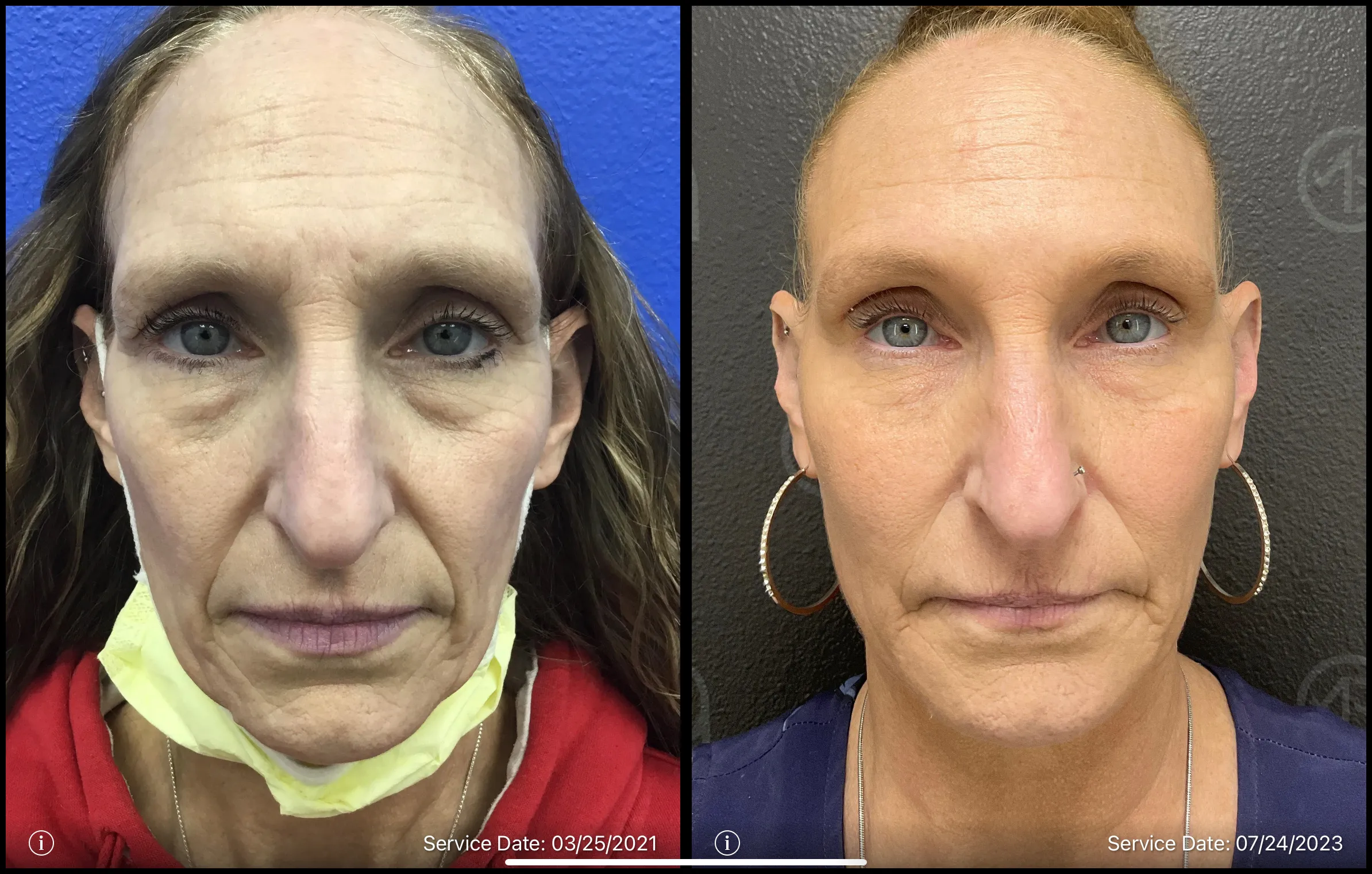 Before and after | wrinkles reduction treatment | ANEU Medical Spa, LLC | McFarland | Madison, WI