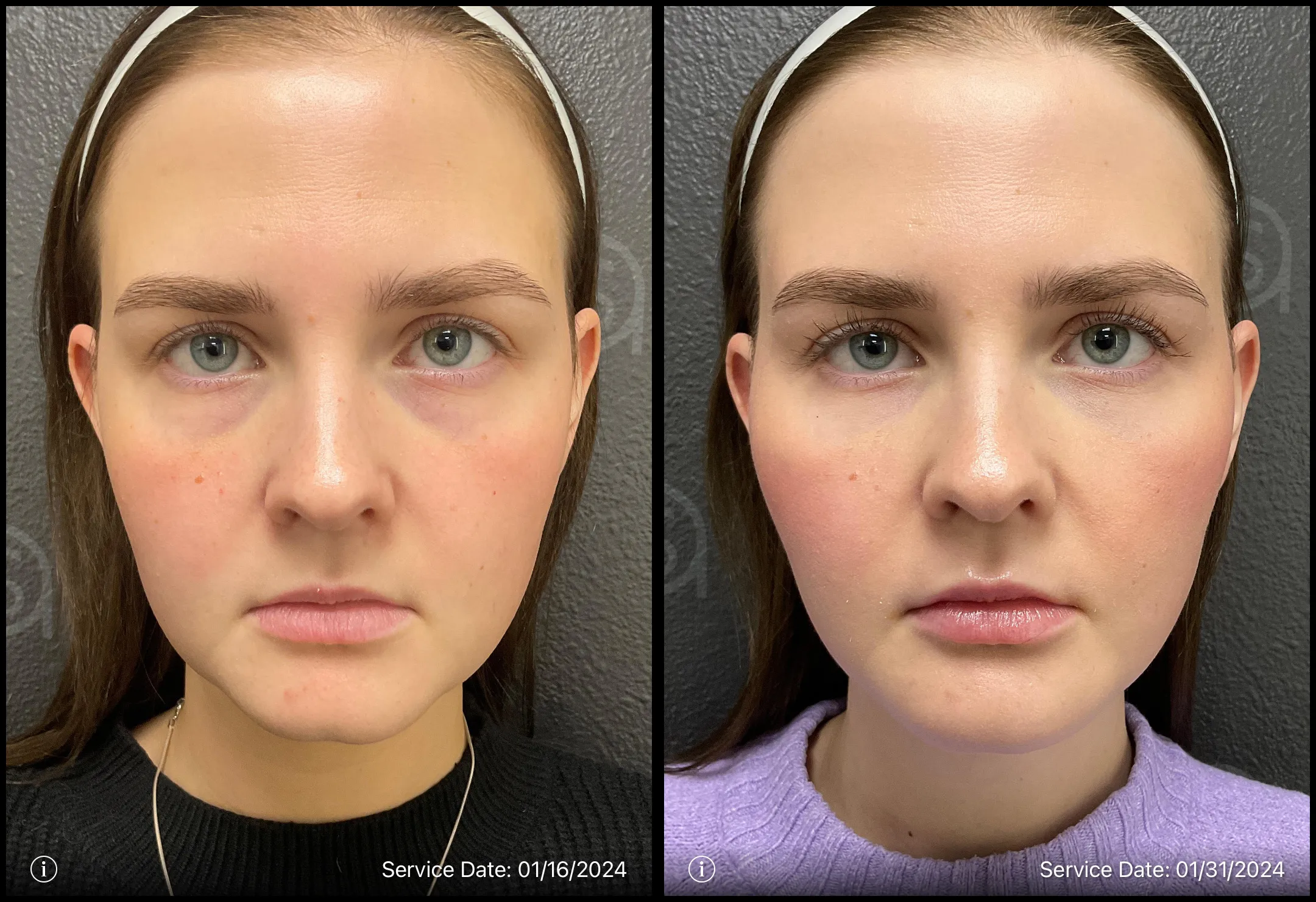 a comparison of a woman's facial skin wrinkles treatment | ANEU Medical Spa, LLC | McFarland | Madison, WI