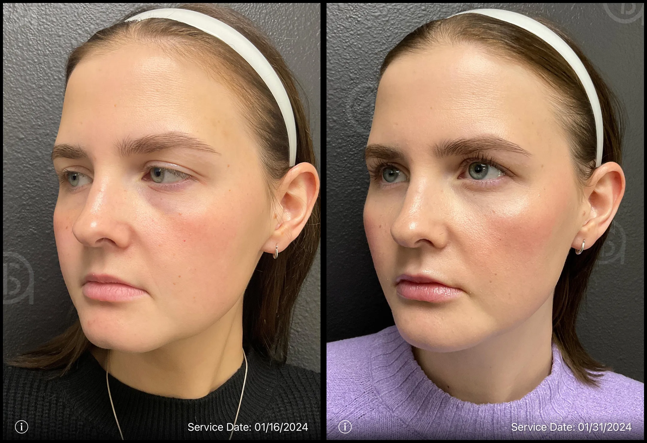 Before and after | tired eyes treatment | ANEU Medical Spa, LLC | McFarland | Madison, WI