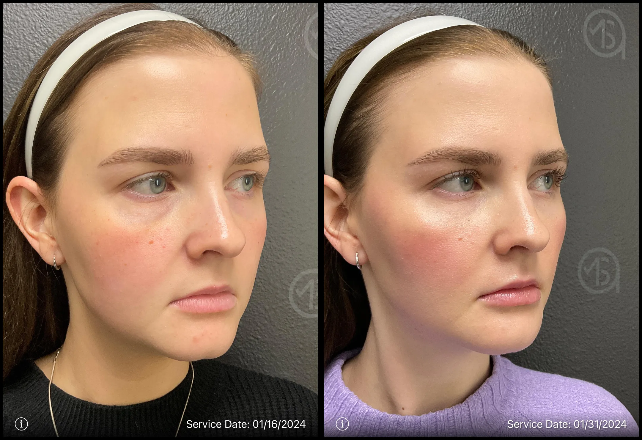 Before and after | prp treatment for under eyes | ANEU Medical Spa, LLC | McFarland | Madison, WI