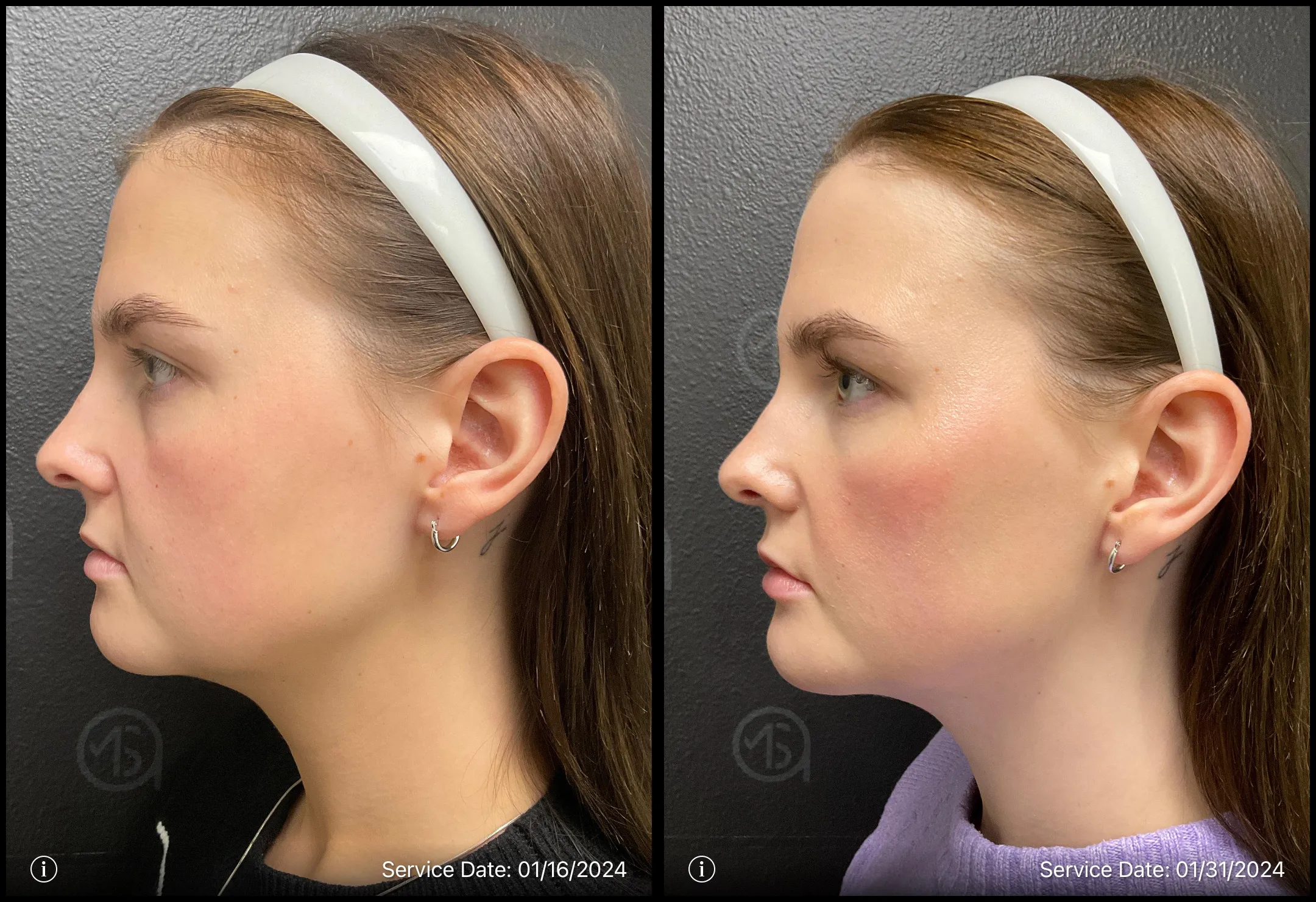 Before and after | prp treatment for under eye correction | ANEU Medical Spa, LLC | McFarland | Madison, WI