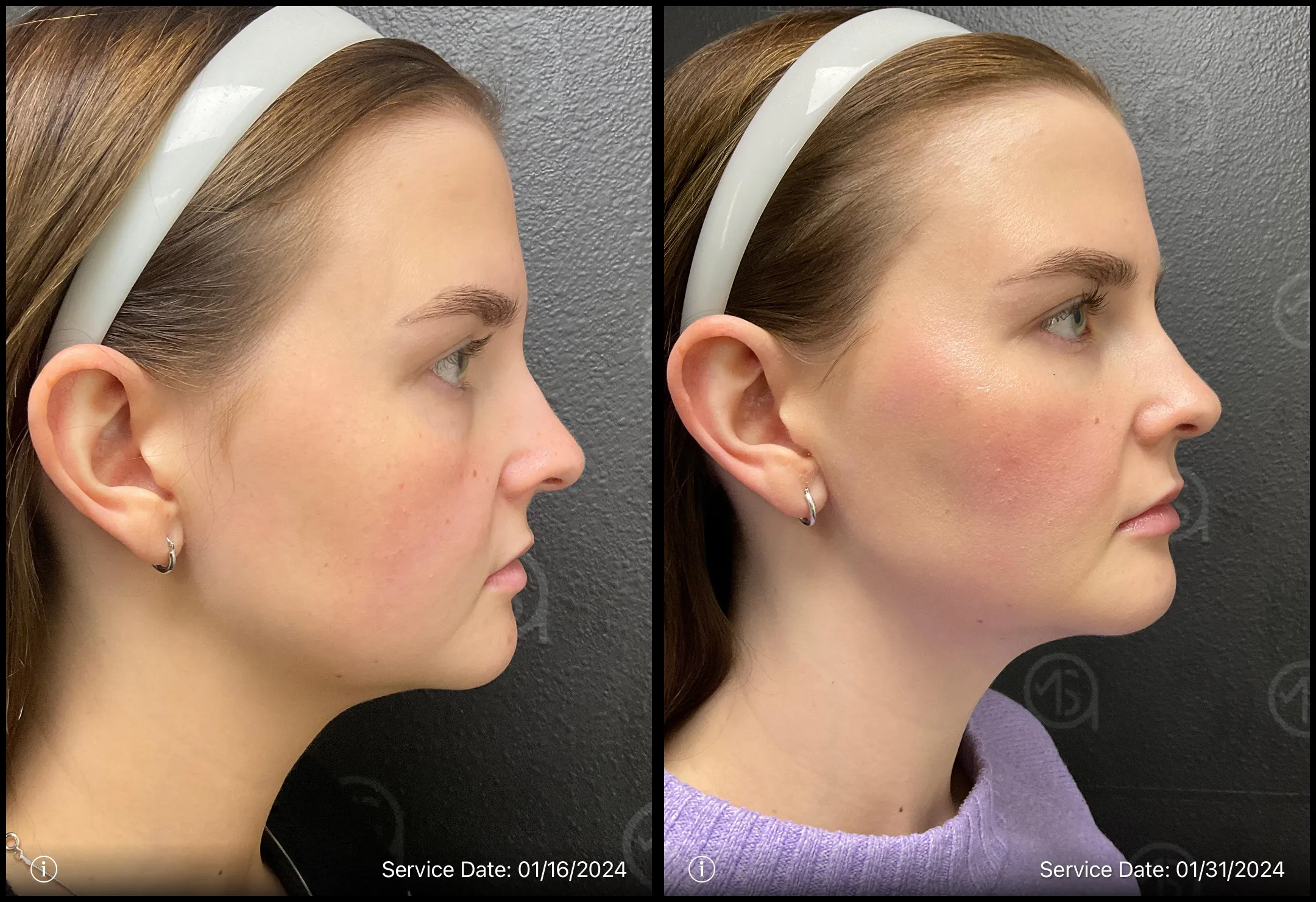 Before and after | deep set eyes treatment | ANEU Medical Spa, LLC | McFarland | Madison, WI
