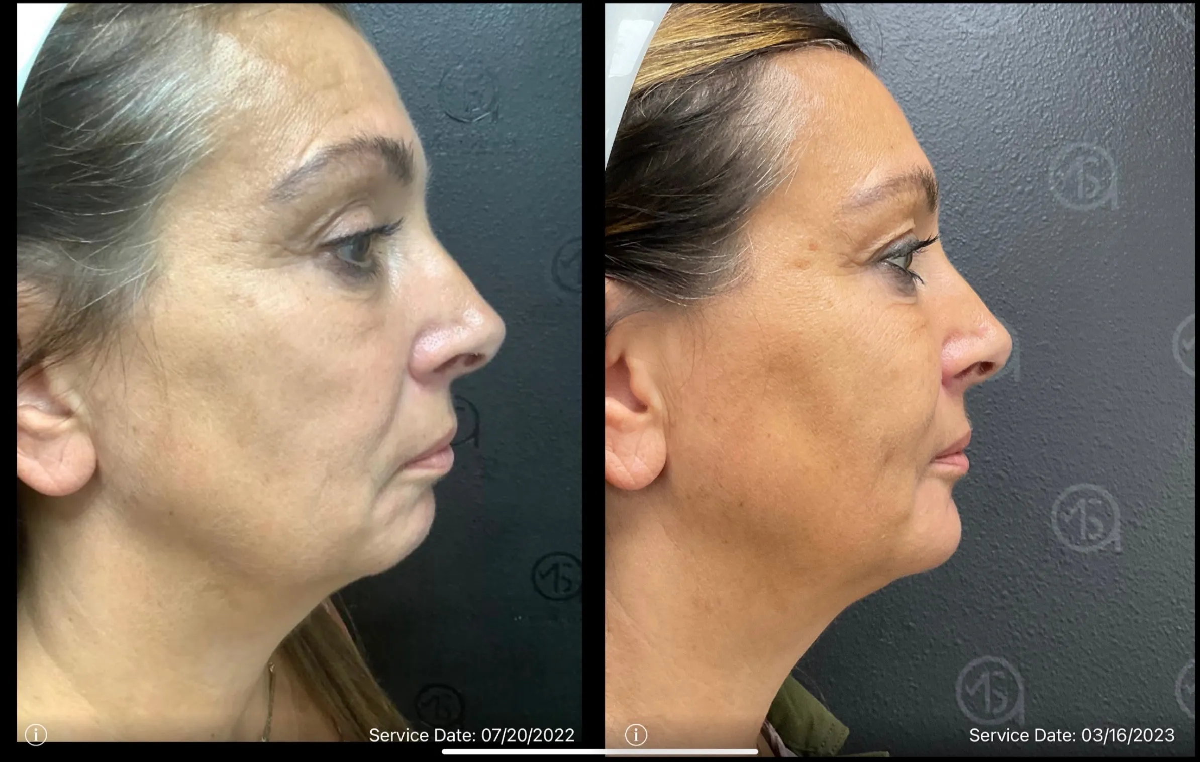 Before and after | double chin treatment | ANEU Medical Spa, LLC | McFarland | Madison, WI