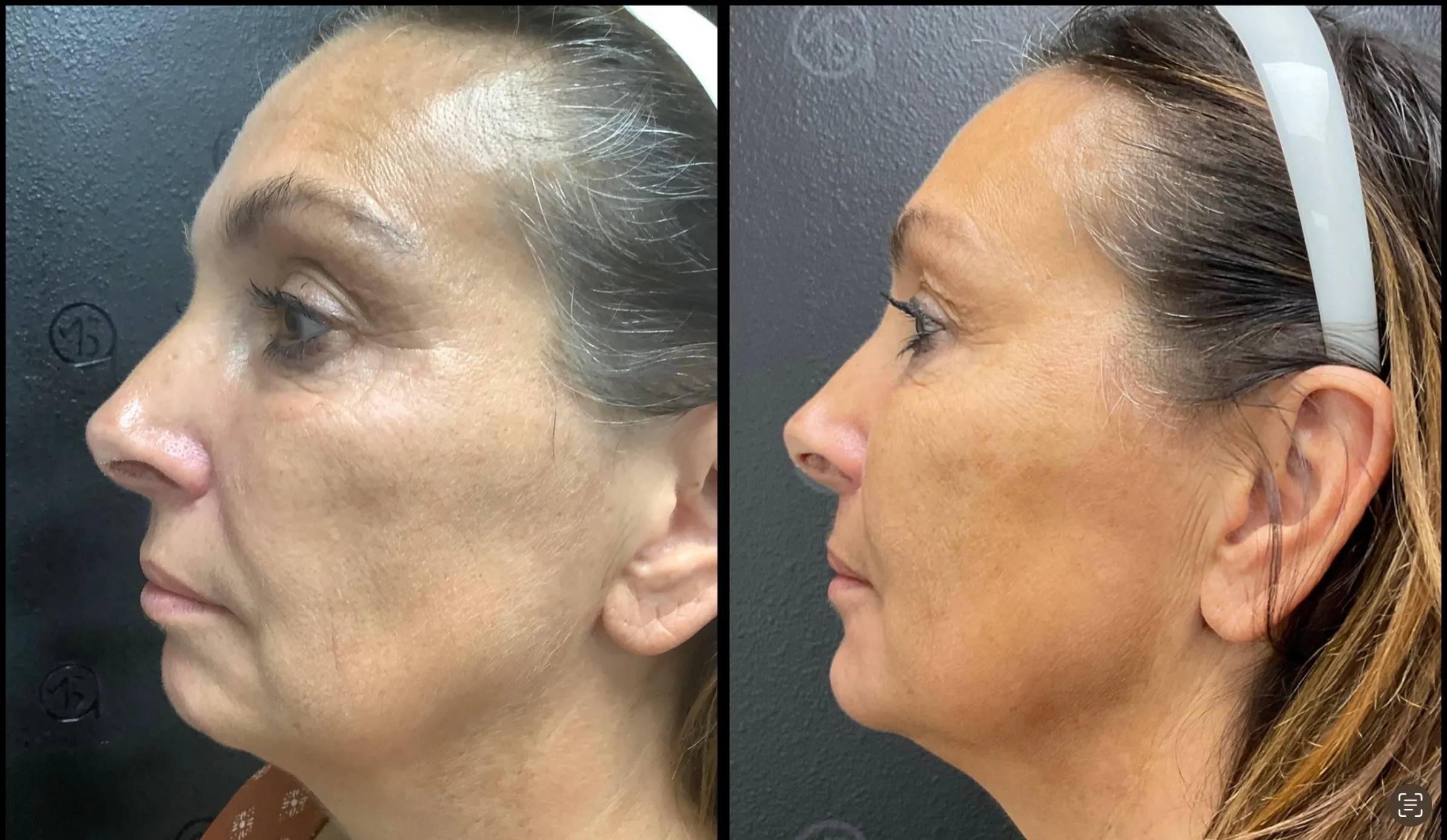 Before and after | chin fat loss | ANEU Medical Spa, LLC | McFarland | Madison, WI