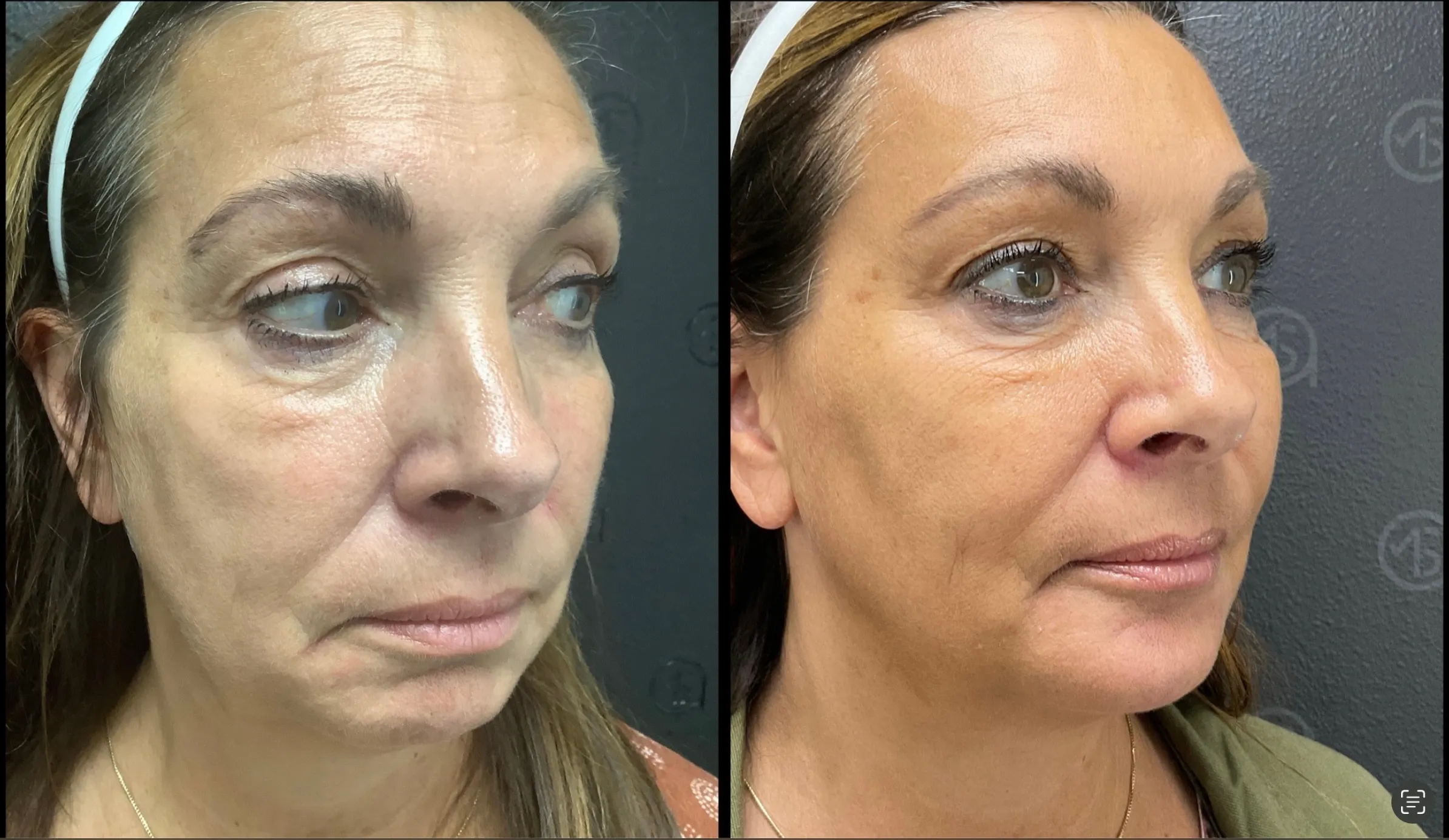 Before and after | jawline contouring | ANEU Medical Spa, LLC | McFarland | Madison, WI
