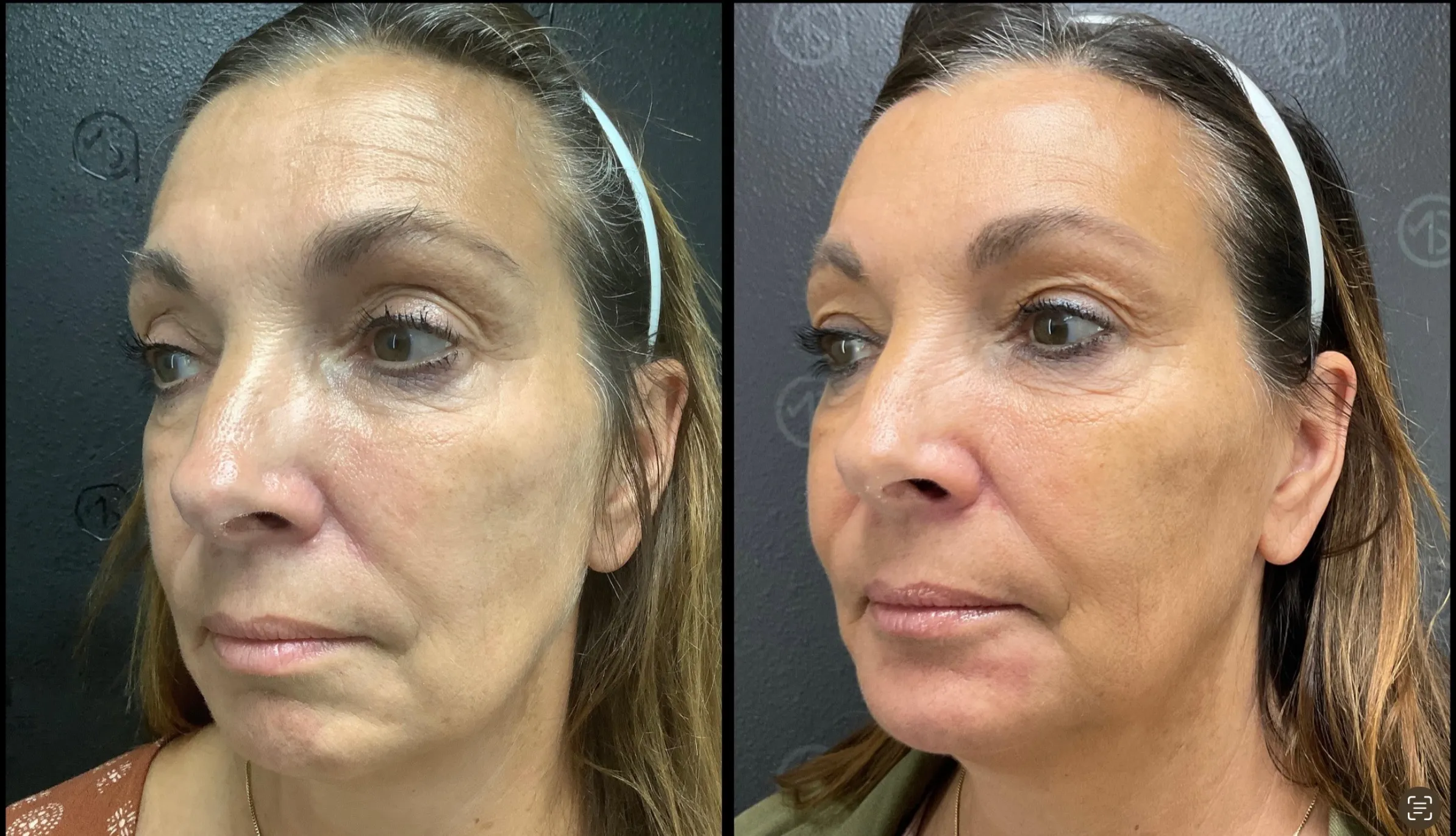 Before and after | chin reduction | ANEU Medical Spa, LLC | McFarland | Madison, WI
