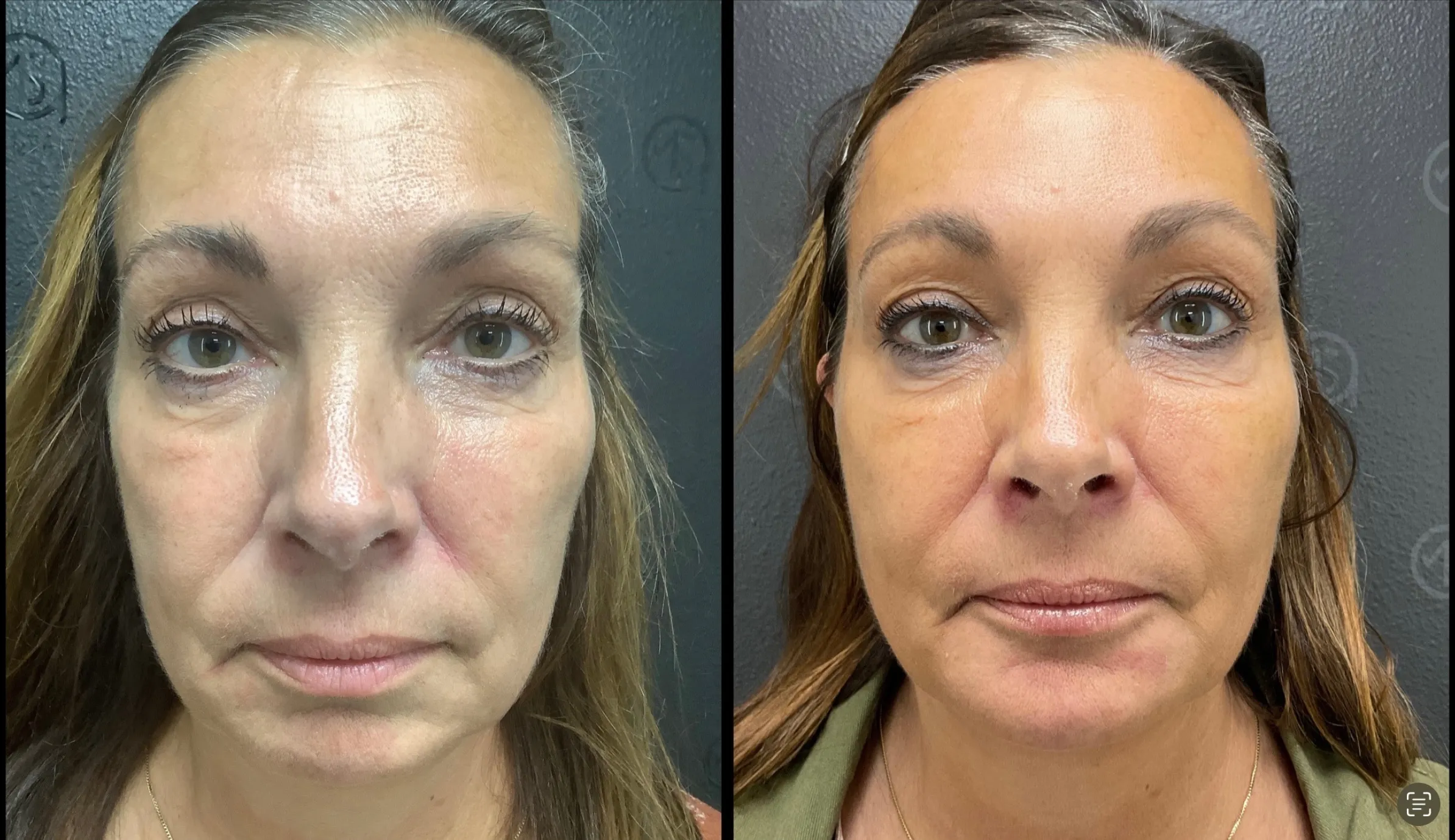 Before and after | kybella for double chin | ANEU Medical Spa, LLC | McFarland | Madison, WI