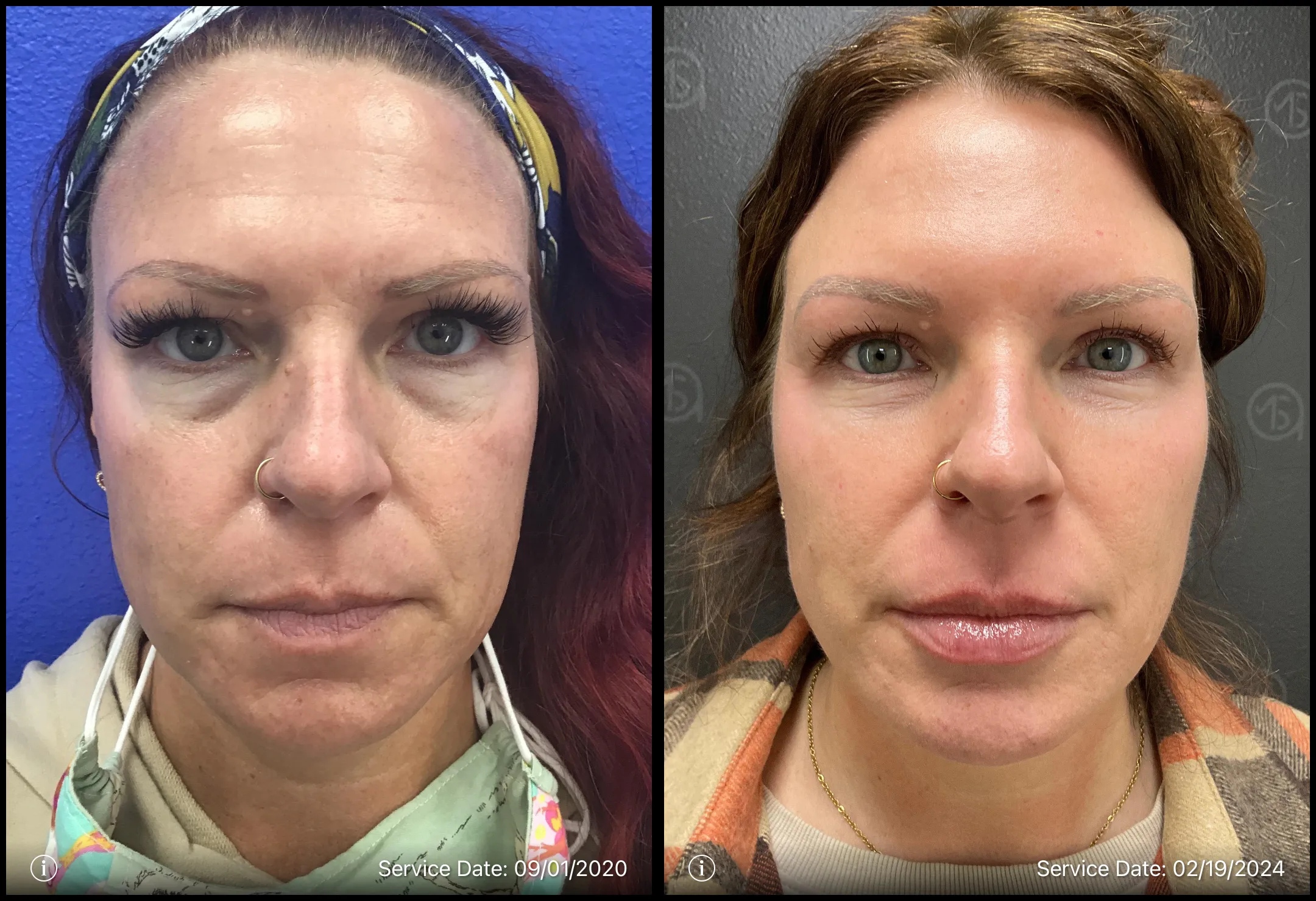 Before and after | skin rejuvenation | ANEU Medical Spa, LLC | McFarland | Madison, WI