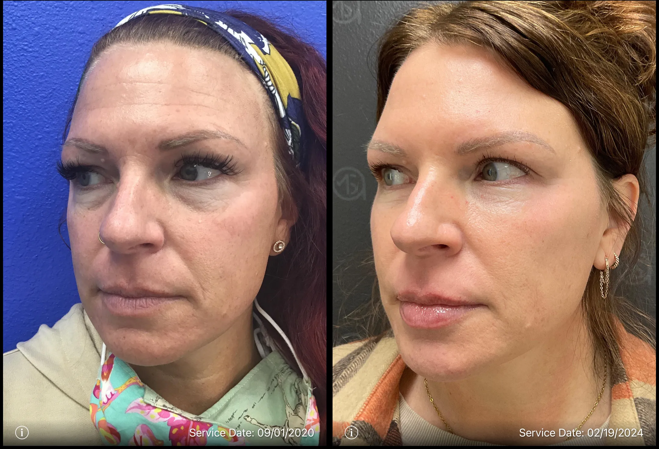 Before and after | facial skin rejuvenation | ANEU Medical Spa, LLC | McFarland | Madison, WI